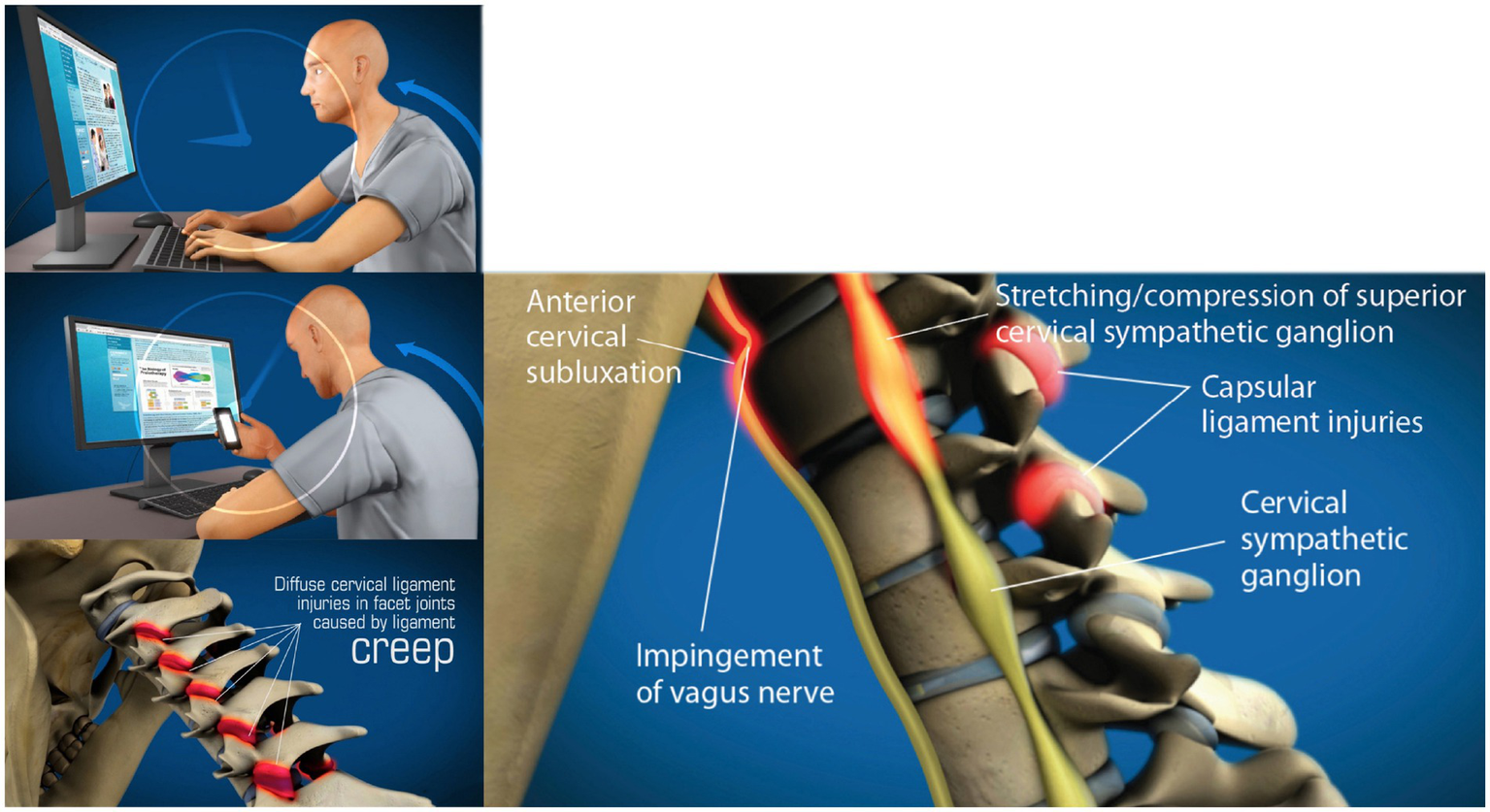 Illustration showing the effects of poor posture on the cervical spine. The top image depicts a person at a computer with slumped posture. The bottom image focuses on a close-up of the cervical spine with highlighted areas indicating anterior cervical subluxation, stretching or compression of the superior cervical sympathetic ganglion, capsular ligament injuries, and vagus nerve impingement. Arrows and labels identify each issue, emphasizing the term “creep” associated with diffuse ligament injuries.