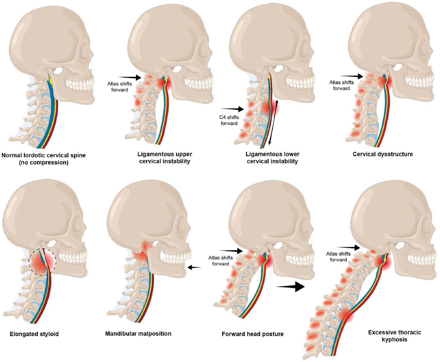 Illustration showing eight side-view diagrams of a human skull and cervical spine. Top row: Normal lordotic cervical spine, ligamentous upper cervical instability, ligamentous lower cervical instability, cervical dysstructure. Bottom row: Elongated styloid, mandibular malposition, forward head posture, excessive thoracic kyphosis. Each diagram highlights specific areas of instability, compression, or misalignment with labels and arrows indicating shifts in vertebrae or the atlas.