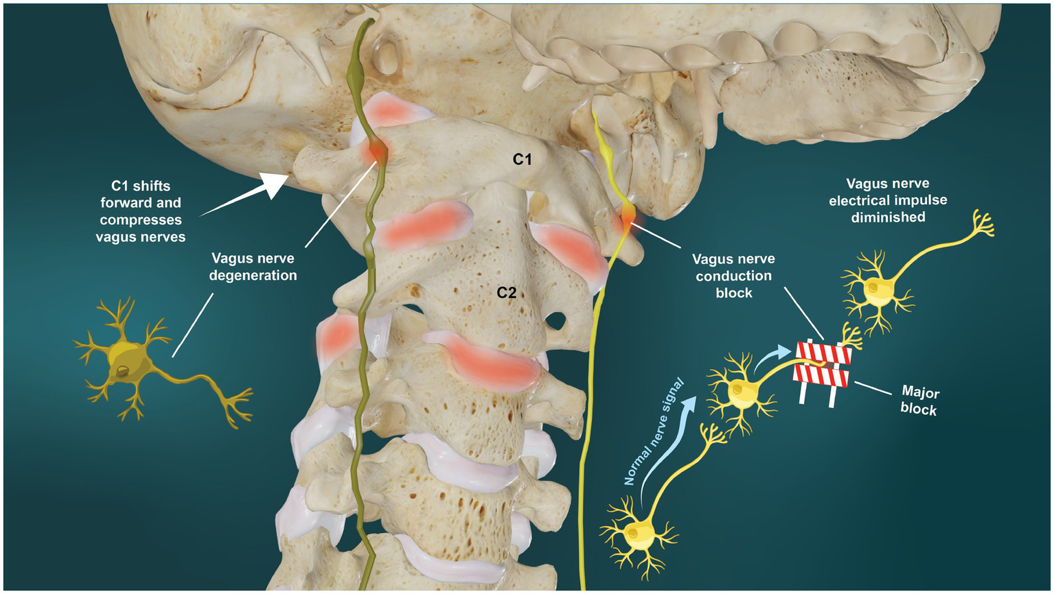 Illustration of the cervical spine showing the C1 vertebra shifting forward, compressing the vagus nerves. Labels indicate vagus nerve degeneration and a conduction block. Arrows depict the path of nerve signals, with a major block and diminished electrical impulse detailed on the right.