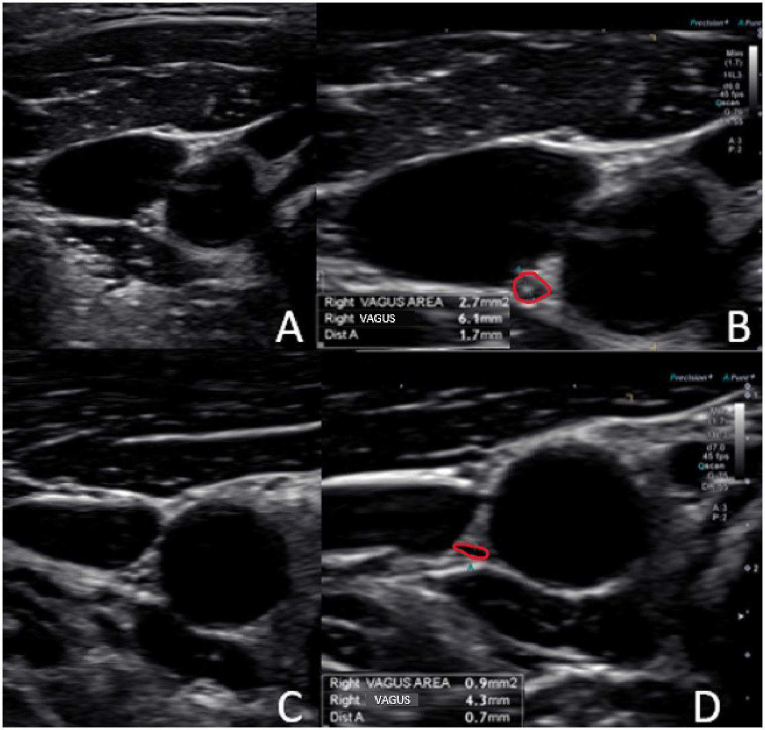 Ultrasound images labeled A to D showing the right vagus nerve. Image A displays a transverse view. Image B highlights the nerve with a circle and notes a 2.7 millimeter square area, 6.1 millimeter diameter, and 1.7 millimeter distance. Image C focuses again on the transverse view. Image D presents the nerve with a circle and lists a 0.9 millimeter square area, 4.3 millimeter diameter, and 0.7 millimeter distance.