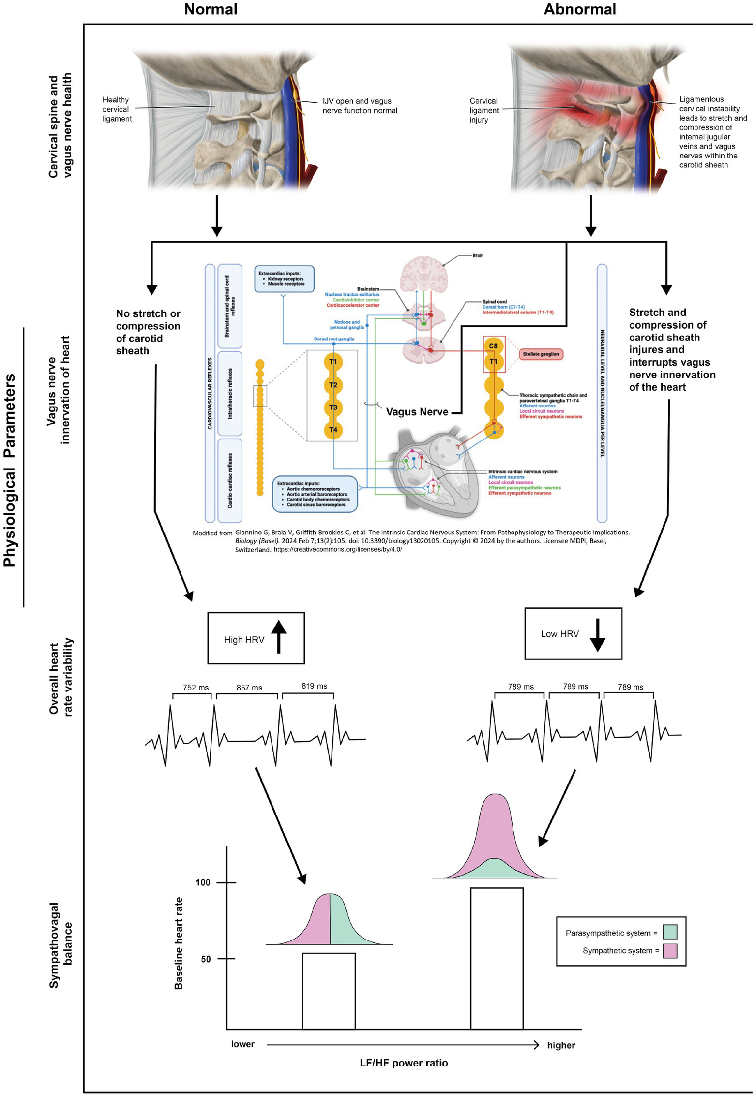 Illustration comparing normal and abnormal cervical spine and vagus nerve function. On the left, a healthy cervical ligament with open LIV and normal vagus nerve function shows no stretch of the carotid sheath, resulting in high heart rate variability (HRV). On the right, cervical ligament injury leads to compression of the carotid sheath, disrupting vagus nerve innervation, which lowers HRV. Graphs show differences in LF/HF power ratio, indicating changes in sympathovagal balance, with the parasympathetic and sympathetic systems represented in green and pink, respectively.