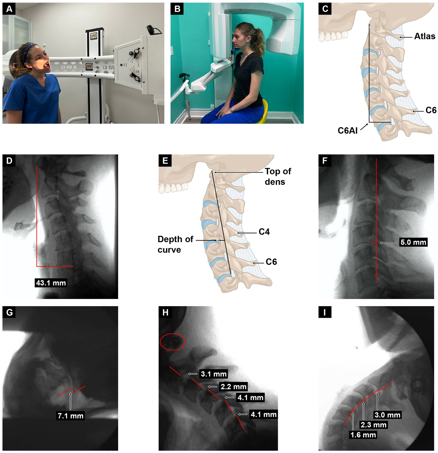 A collage of cervical spine imaging and diagrams: A) A person undergoing DMX imaging, standing oriented sideways. B) Another imaging procedure with the person seated. C) Diagram of the cervical spine showing the atlas through C6. D) Radiograph with a measurement of 43.1 mm. E) Diagram illustrating spinal curvature depth from the top of the dens to C6. F) Radiograph with a measurement of 5.0 mm. G) Radiograph with a measurement of 7.1 mm. H) Radiograph showing multiple measurements: 3.1 mm, 2.2 mm, two instances of 4.1 mm. I) Radiograph with measurements: 3.0 mm, 2.3 mm, and 1.6 mm.