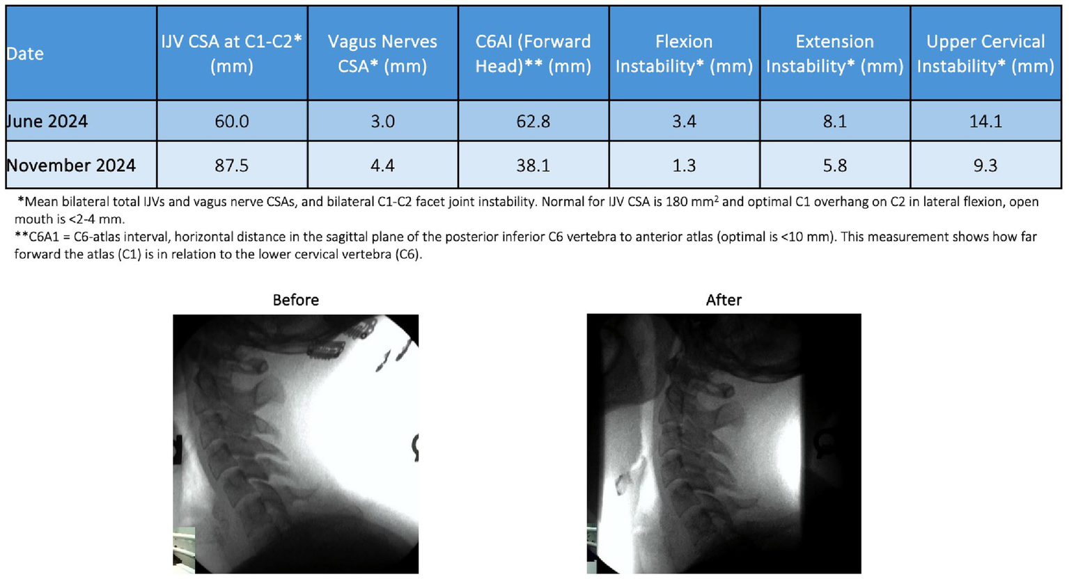 Table showing measurements of various cervical spine parameters taken in June and November 2024, including IJV CSA, Vagus Nerves CSA, C6AI, Flexion Instability, Extension Instability, and Upper Cervical Instability. Below are two lateral cervical spine X-ray images labeled “Before” and “After,” indicating changes after a period.
