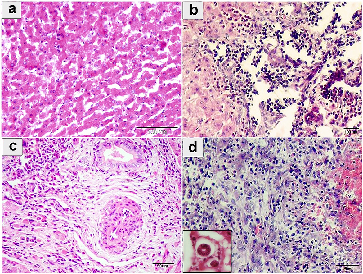 Four panels of histological images labeled a, b, c, and d. Panel a shows normal liver tissue with dense, uniform cells. Panel b depicts inflammatory cell infiltration with less organized cellular structure. Panel c features fibrous tissue formation, indicating scarring. Panel d reveals extensive cellular degeneration and inflammation, with an inset showing a close-up of an abnormal cell. Each panel highlights different pathological liver conditions, magnified at varying scales.