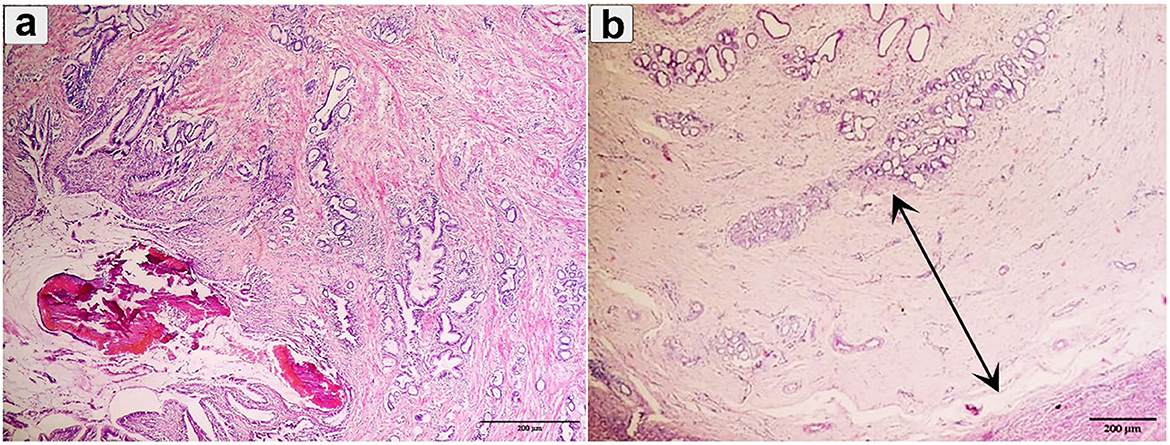 Histological slides with labeled sections (a) and (b). Section (a) shows dense cellular structures with varying textures stained in pink and purple, measuring 500 micrometers. Section (b) highlights a less dense area with a marked black arrow indicating a specific region, measuring 200 micrometers.