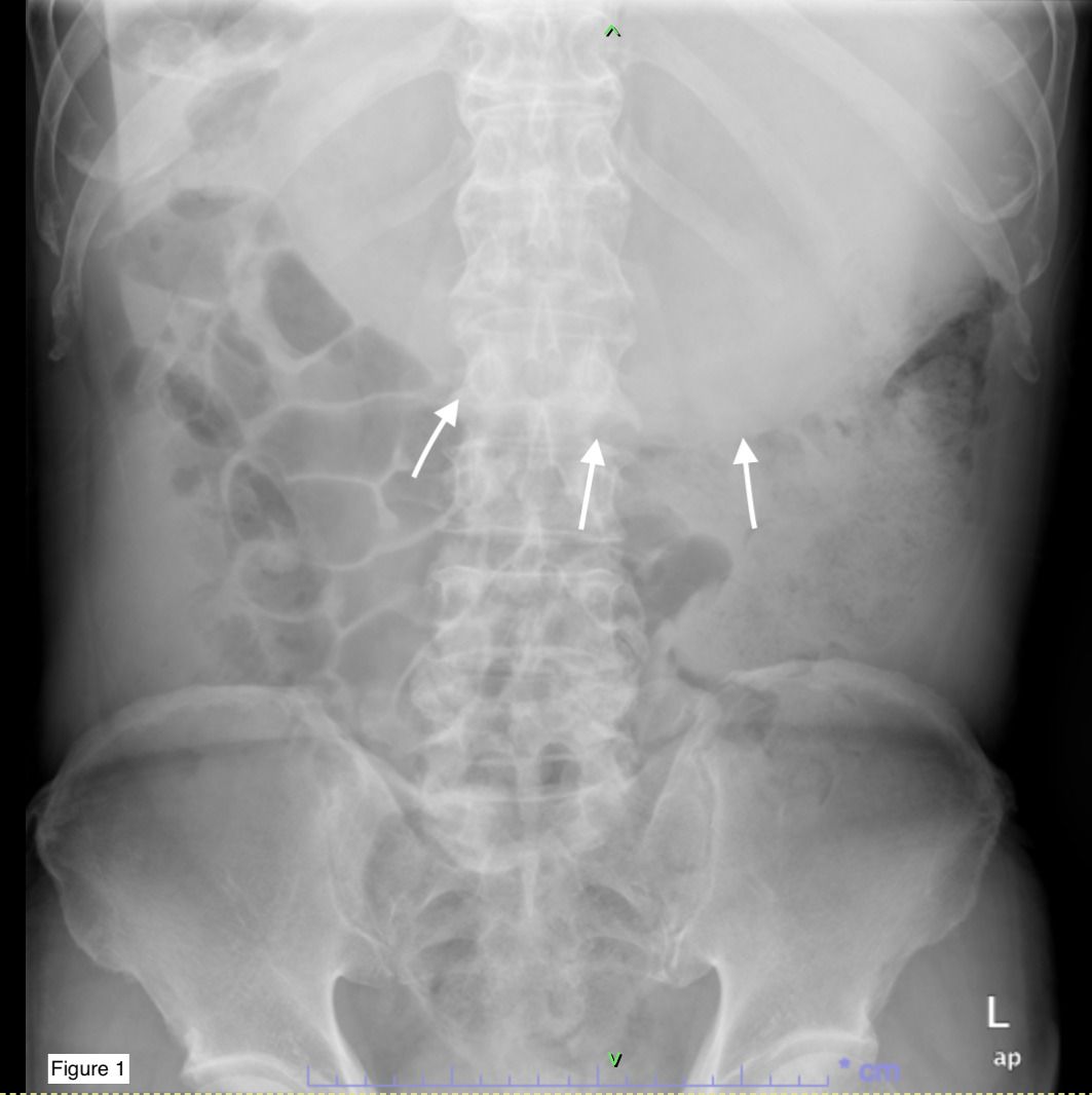 X-ray image of the abdomen showing spinal alignment and pelvic structure. Three arrows point to areas with increased opacity along the spine, possibly indicating calcifications or other abnormalities.