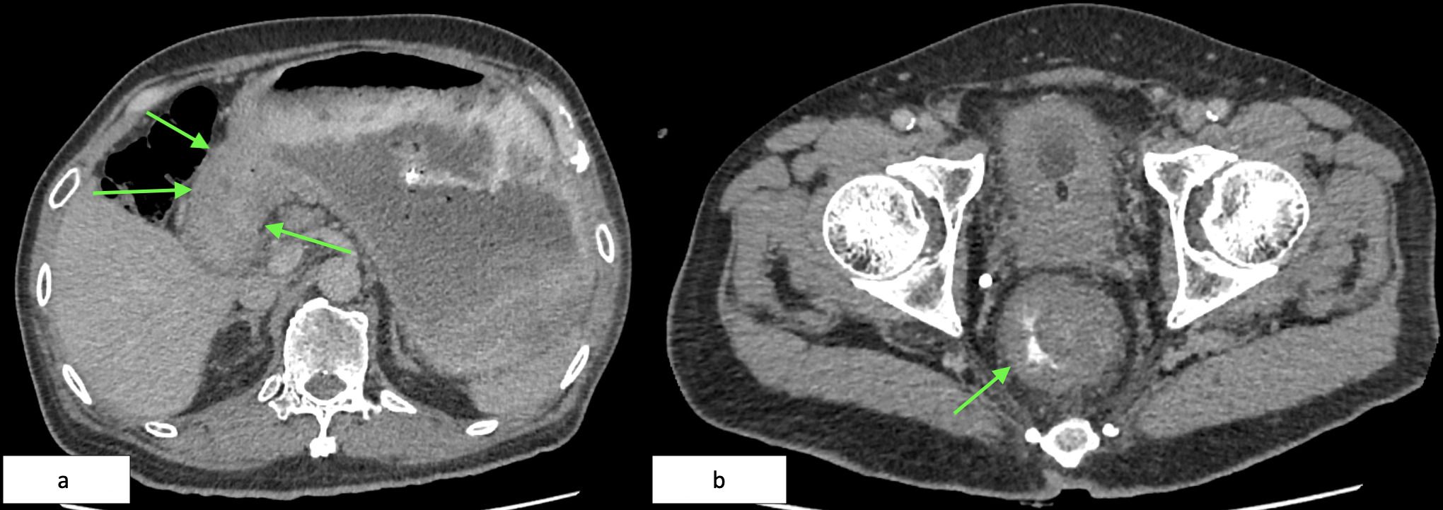 CT scan images labeled Figure 2a and Figure 2b. Figure 2a shows arrows pointing to areas in the abdominal region, possibly indicating abnormalities or points of interest. Figure 2b highlights a similar focus in the pelvic region with one arrow. Both images display cross-sectional views of the body with different structures visible.