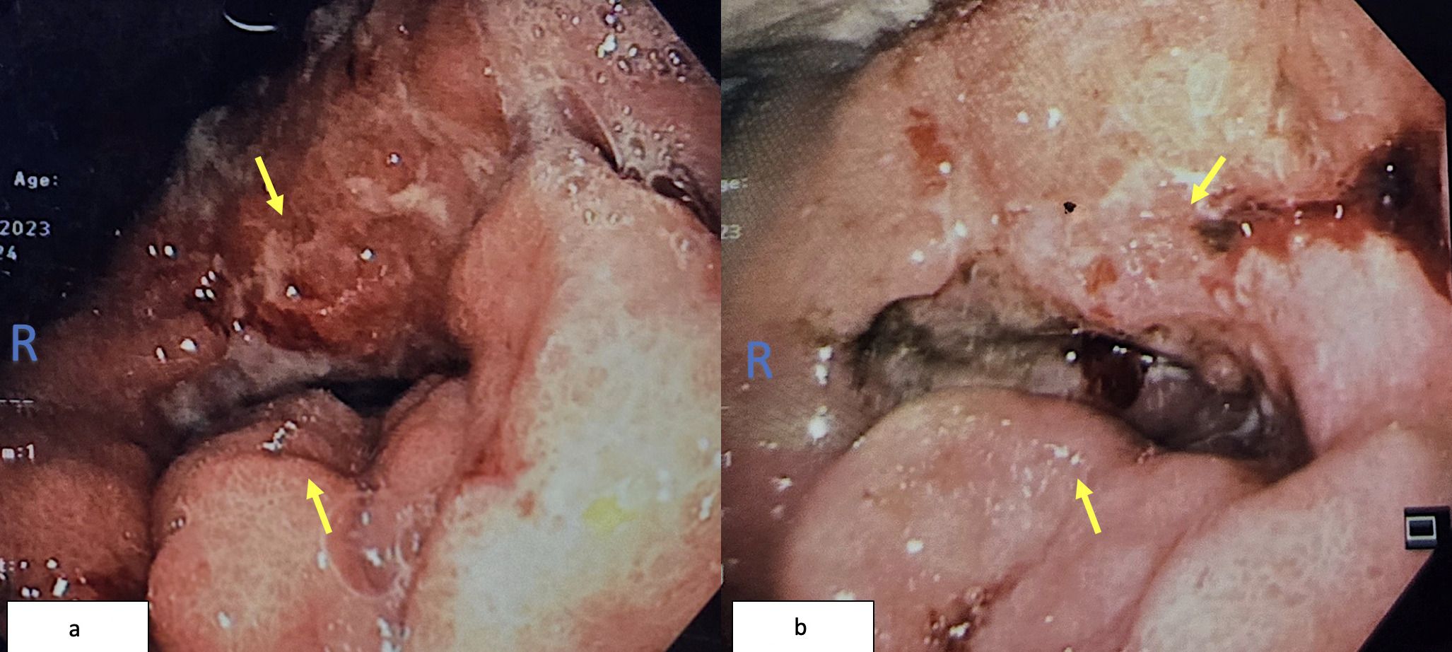 Endoscopic images labeled Figure 3a and Figure 3b. Both images depict the esophagus with visible abnormalities highlighted by yellow arrows. Figure 3a shows an irregular, discolored area, while Figure 3b displays a larger lesion with surrounding discoloration.