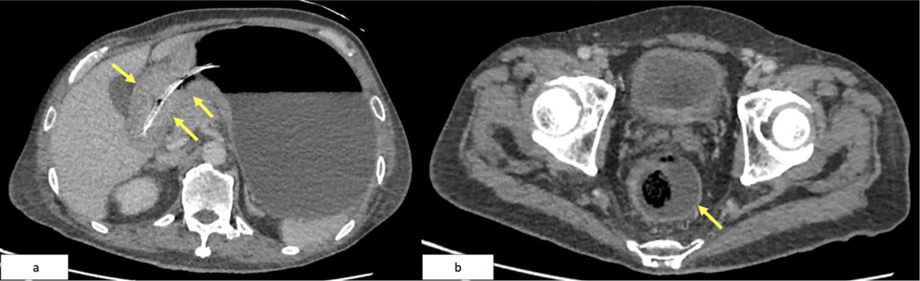 Two CT scan images labeled Figure 5a and Figure 5b. Figure 5a shows the thoracic region with yellow arrows pointing to areas of interest. Figure 5b displays a pelvic cross-section with one yellow arrow highlighting a specific feature. The scans detail anatomical structures and potential abnormalities.