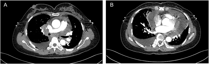 CT scans in two panels labeled A and B show transverse sections of the chest. Panel A displays a large mass in the mediastinum. Panel B highlights changes in lung tissue density with pleural effusion.