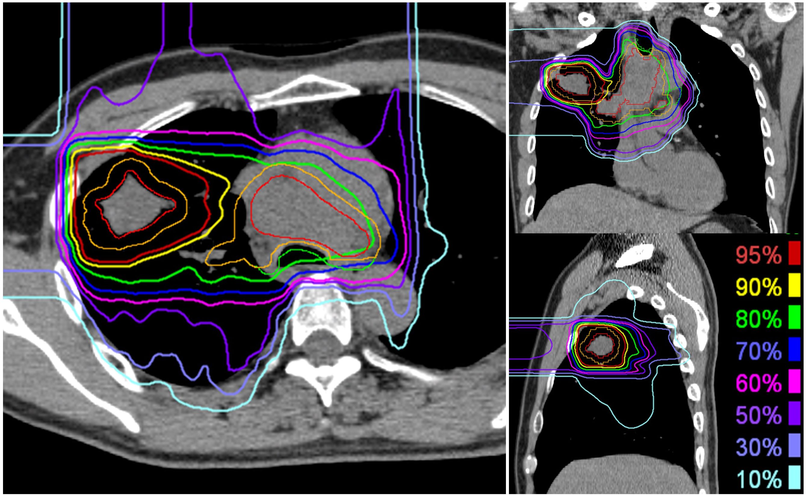 CT scan images showing different cross-sectional views of a thorax with overlaid radiation dose distribution contours. The contours are color-coded to indicate varying radiation intensities from 95% to 10%, as detailed in the legend on the right.