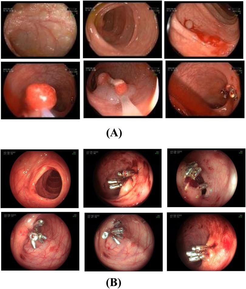 Images depicting colonoscopy procedures. Part A shows various stages of polyp detection, with images of the colon lining, polyps, and minor lesions. Part B displays the process of polyp removal, including tools like clips used to excise polyps.