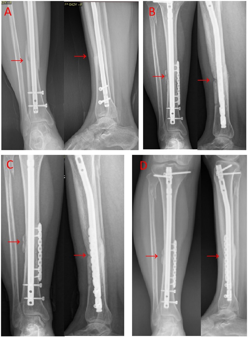 X-rays labeled A through D show lower leg fractures with various orthopedic implants. Arrows indicate the presence of intramedullary nails and screws fixing the tibia. Each image demonstrates different angles and types of fixation hardware.