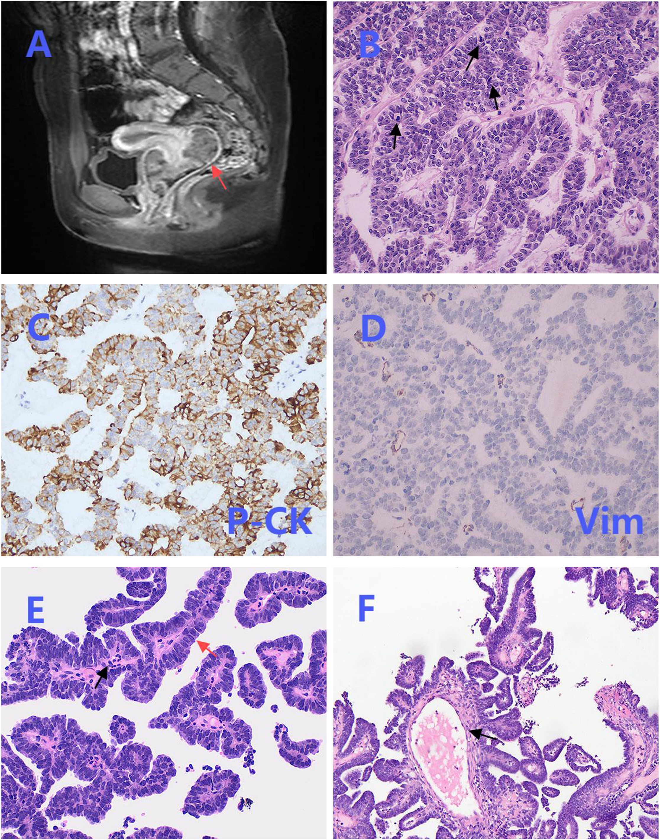 Panel A shows an MRI scan of the pelvic region with a red arrow pointing to a specific area. Panel B displays a histopathological section with densely packed purple stained cells and black arrows indicating features. Panel C features a tissue section with brown staining labeled P-CK. Panel D shows a similar section with lighter staining labeled Vim. Panel E includes a histological image with irregular purple structures, red and black arrows pointing to key areas. Panel F presents another histological view with tubular structures and a black arrow highlighting a detail.