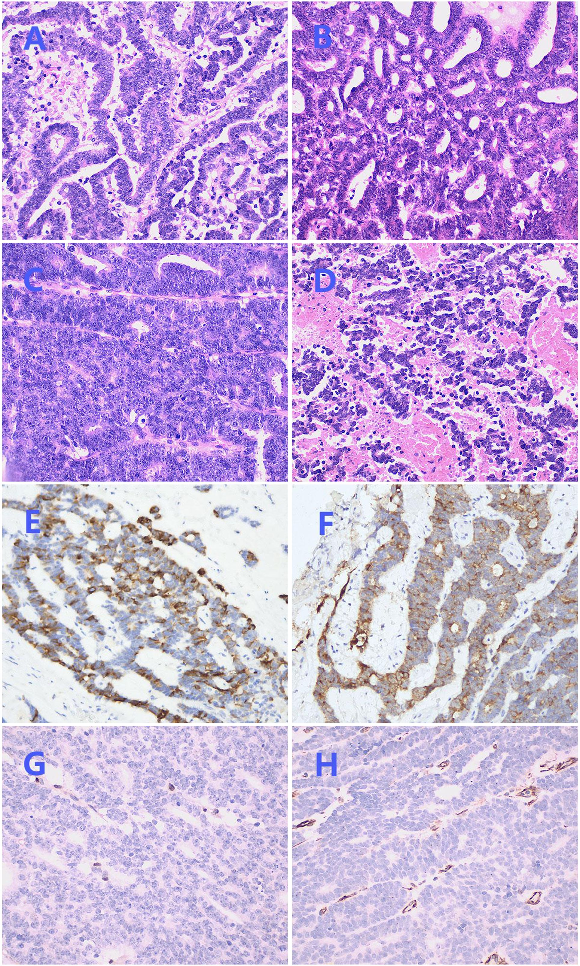 Histological images labeled A to H show various tissue samples. Panels A to D display different views of cellular structures stained in shades of purple and pink. Panels E and F focus on cellular patterns with darker brown highlights against a lighter background, likely indicating specific staining. Panels G and H reveal a uniform distribution of cells stained in purple, with some darker linear features suggesting additional staining techniques.