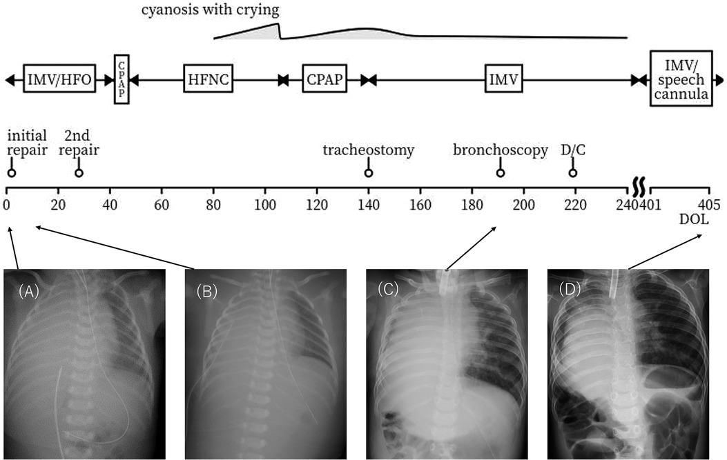 Timeline of medical procedures with related chest X-rays labeled A, B, C, and D. The timeline indicates various respiratory support methods and events like initial repairs, tracheostomy, and bronchoscopy. Each X-ray corresponds to specific points on the timeline, showing changes in respiratory support and condition over time.