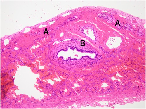 Histological image of hernia sac speciment stained with hematoxylin and eosin. Labeled \