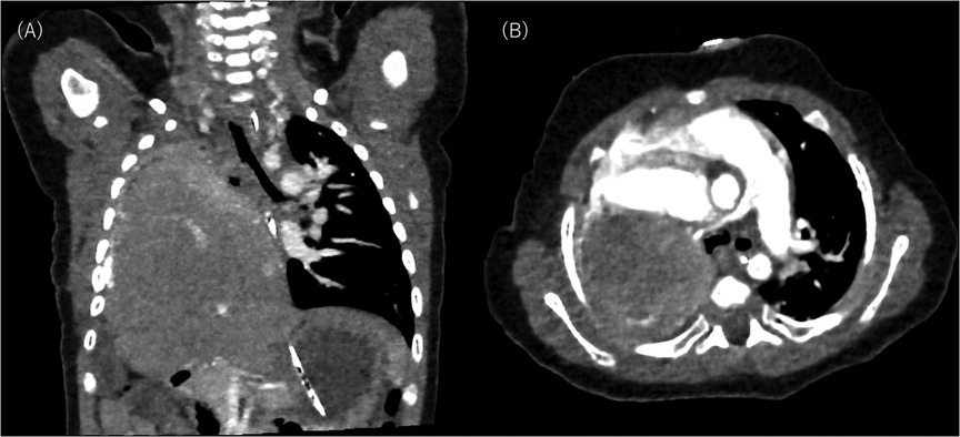CT scan images showing: (A) a coronal view with highlighted anatomical structures including the spine, lung, and heart; (B) a transverse view showing cross-sectional anatomy of similar structures.