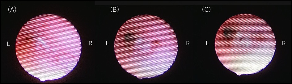 Three panels labled A, B, and C show bronchoscopic images under different inspiratory pressure. Each image is labeled \
