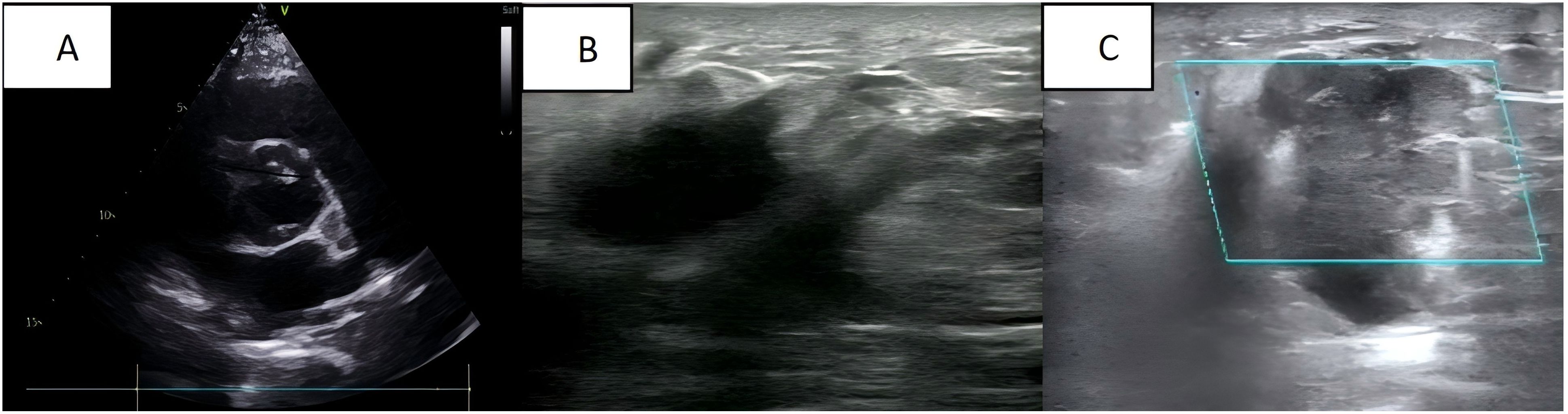 Three ultrasound images labeled A, B, and C. Image A shows a heart ultrasound with distinct chamber structures. Image B displays a more homogenous, less defined area, possibly soft tissue. Image C shows a region with a highlighted rectangular area indicating a focus of interest.