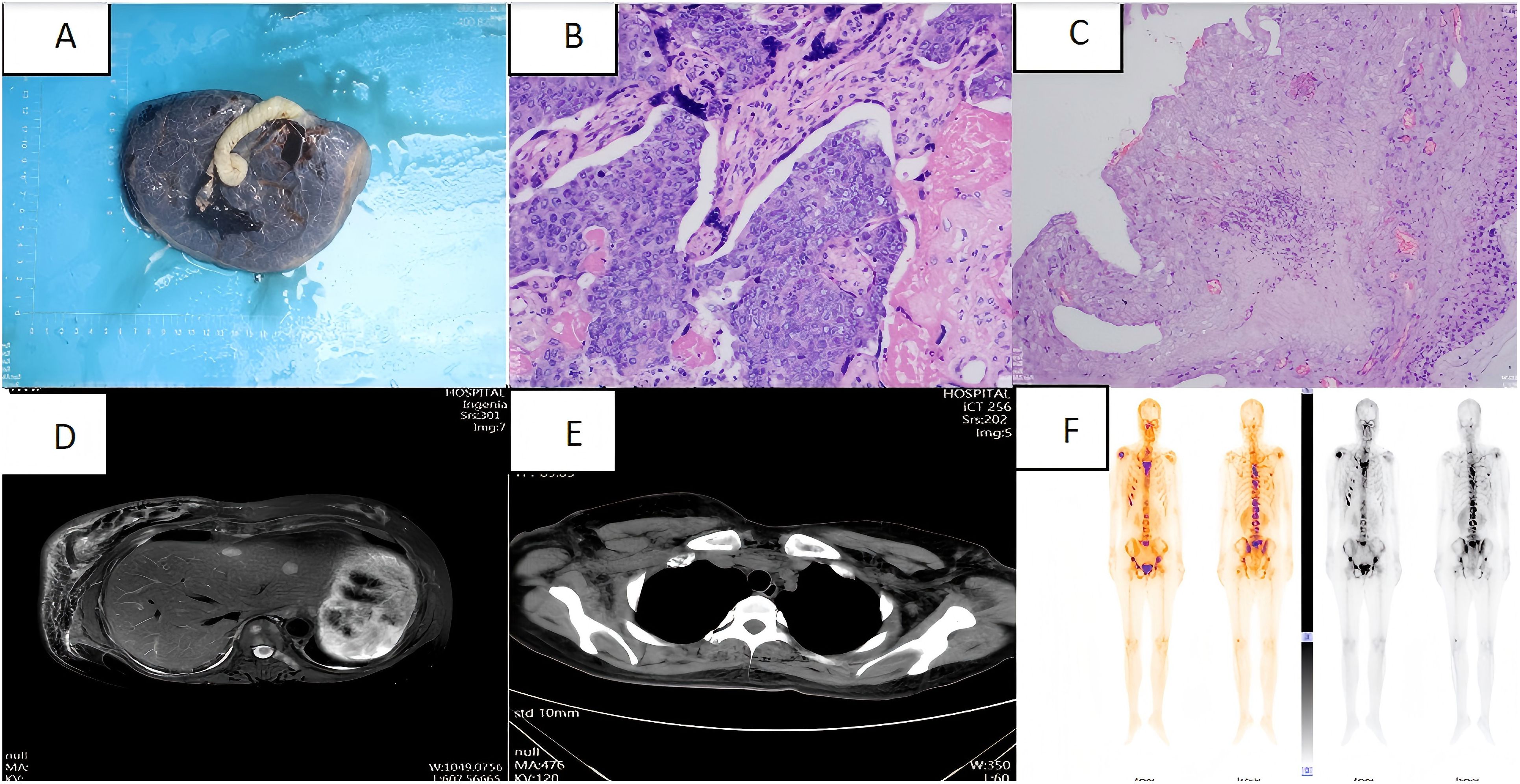 Image A shows the placenta specimen of a lung with a large, coiled parasite inside. Image B is a histological slide showing tissue with a dense cell cluster. Image C displays a histological section with disrupted tissue organization. Image D is a grayscale MRI scan of a cross-section of the chest. Image E shows a CT scan of the upper torso, highlighting skeletal and soft tissue structures. Image F consists of PET and bone scans of a human figure, with areas of increased uptake shown in color.