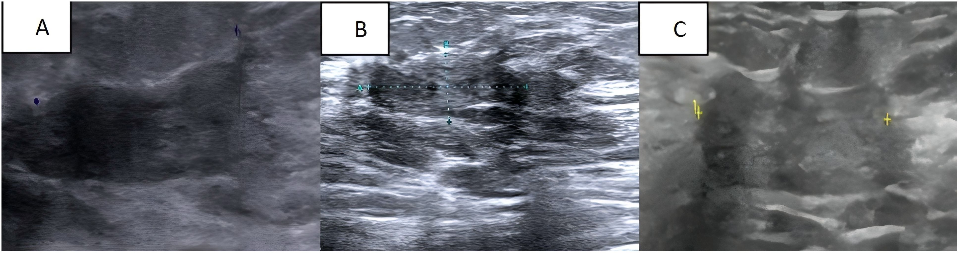 Three grayscale ultrasound images labeled A, B, and C. Image A shows a dark, uneven texture. Image B features a crosshair marking and dotted lines indicating measurements. Image C displays another crosshair, with a clearer depiction of layered structures.