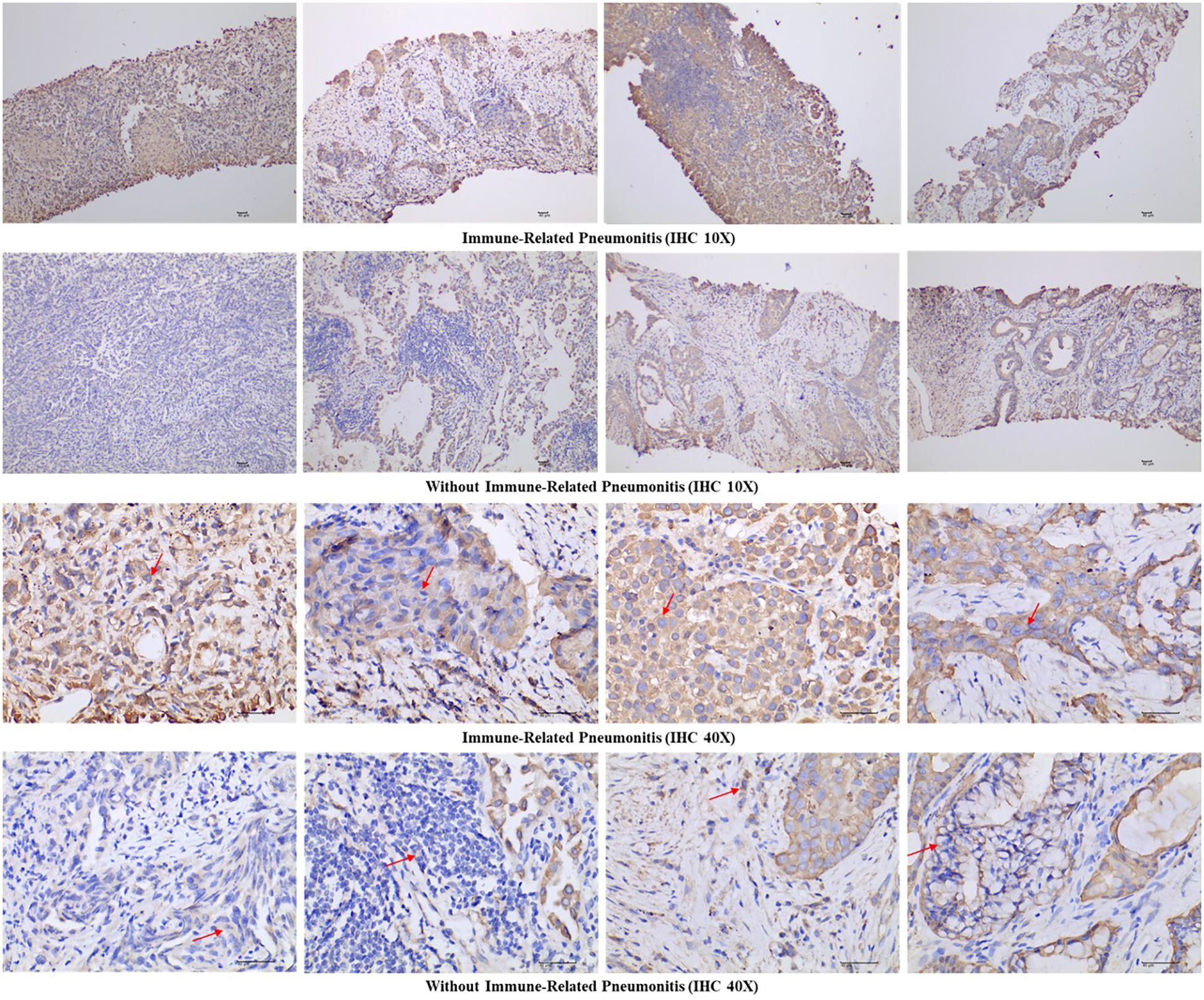 Microscopic images showing tissue samples stained with immunohistochemistry (IHC) at two magnifications: 10X and 40X. The top row compares samples with immune-related pneumonitis at 10X, displaying brown staining indicative of immune activity. The second row shows samples without pneumonitis at the same magnification, with less staining. The third row, at 40X, highlights specific immune activity with arrows in pneumonitis cases. The bottom row, also at 40X, shows samples without pneumonitis, with minimal brown staining and arrows indicating specific points of interest.