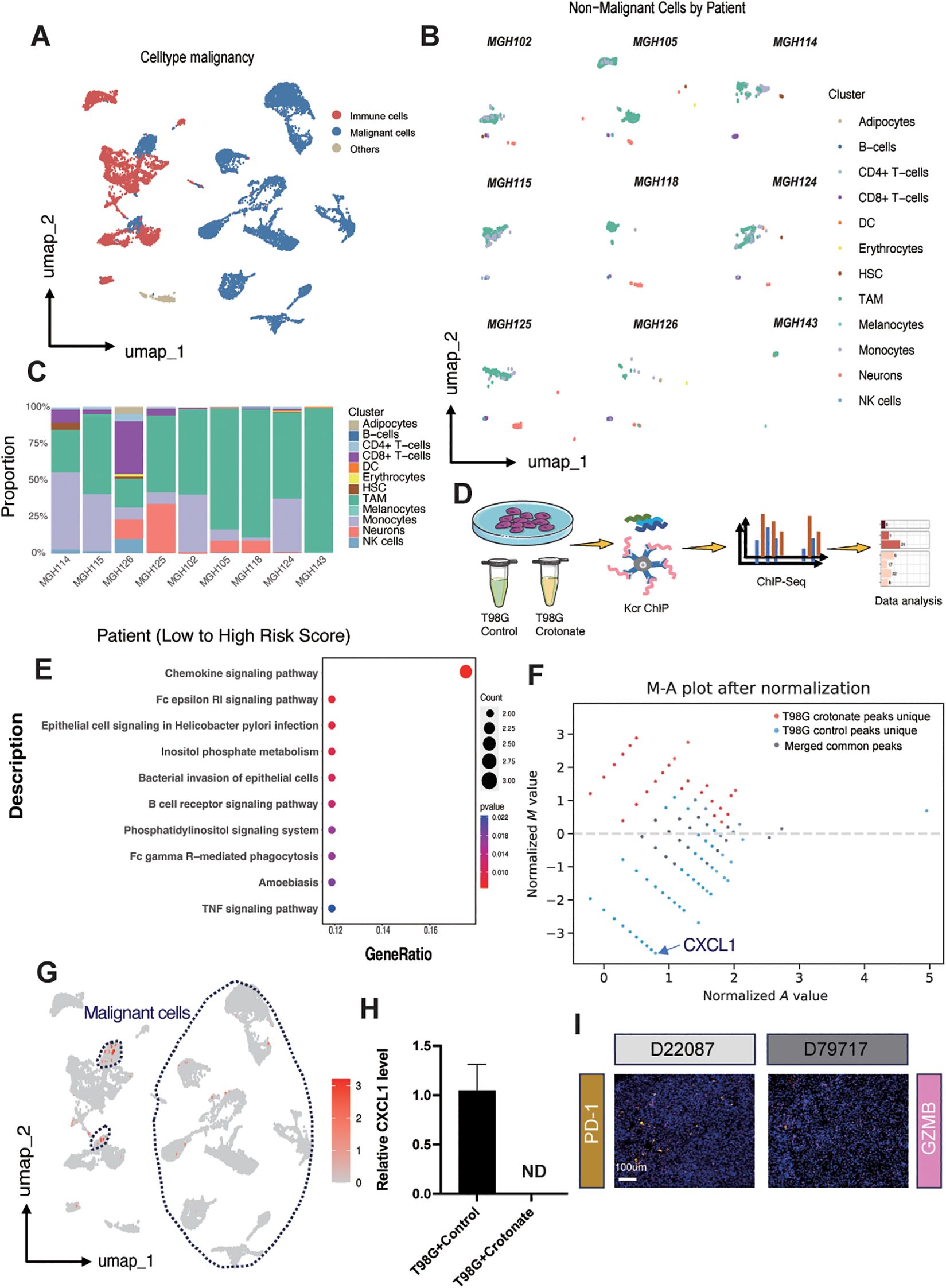 A series of scientific data visualizations related to cell type analysis and gene expression: A) UMAP plot categorizing cell types by malignancy. B) UMAP plots showing non-malignant cells per patient. C) Bar graph of cell type proportion per patient. D) Diagram of ChIP-Seq workflow for T98G control and T98G crotonate. E) Dot plot of gene pathways against gene ratio. F) M-A plot after normalization highlighting gene CXCL1. G) UMAP plot focusing on malignant cells. H) Bar graph comparing relative CXCL1 levels in T98G control and crotonate. I) Histology images for cell markers PD-1 and GZMB.