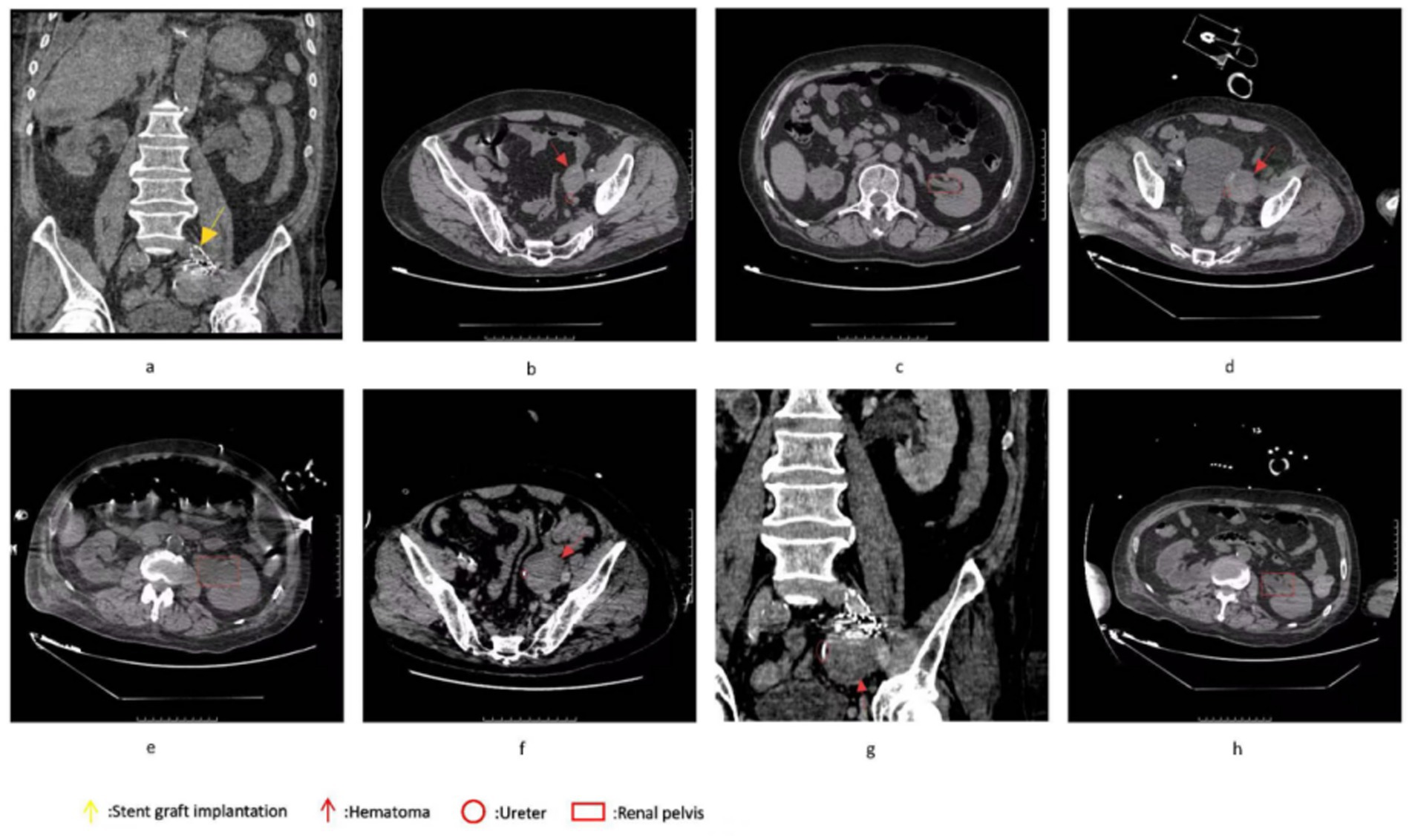 CT scan images in two rows show different abdominal and pelvic cross-sections. Indications include a yellow arrow for stent graft implantation, red arrows for hematomas, circles for ureters, and a rectangle for the renal pelvis. Each image is labeled with letters a to h for reference.