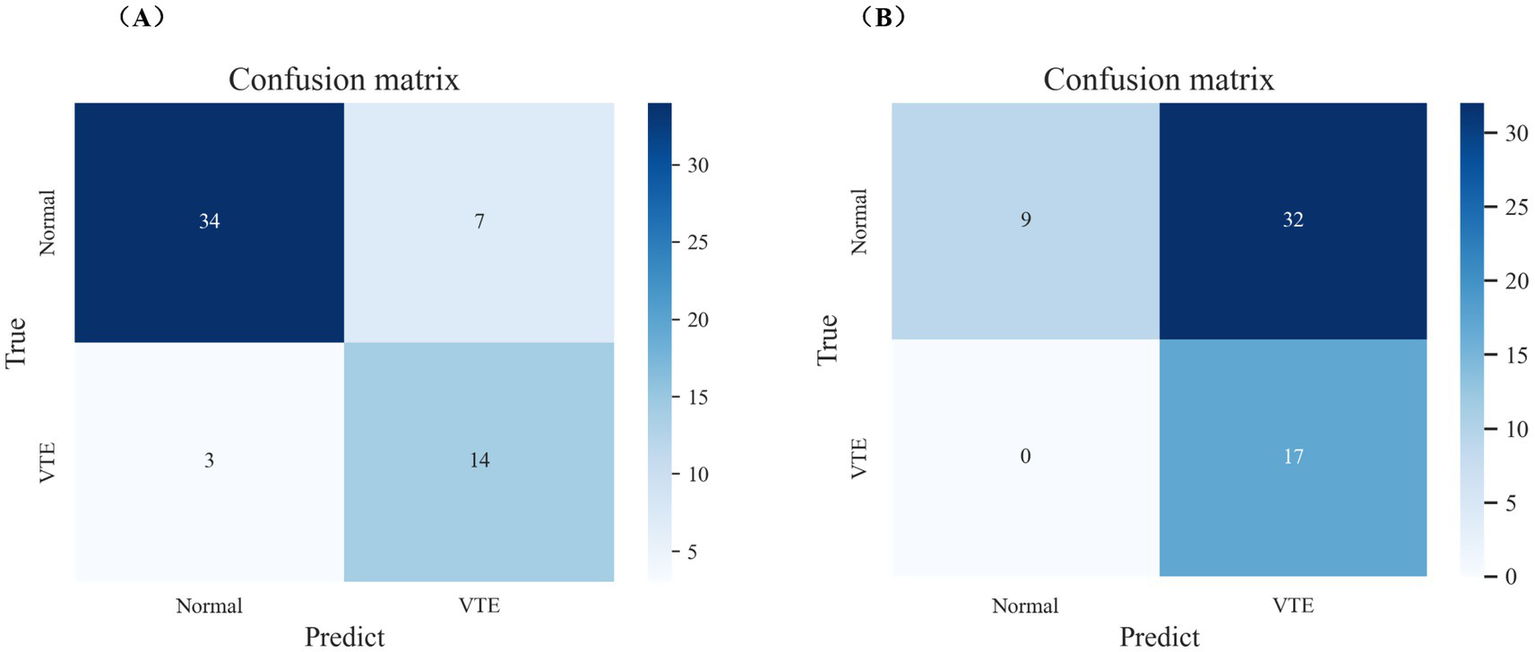 Confusion matrices labeled A and B comparing true versus predicted values for "Normal" and "VTE". Panel A shows 34 true normals, 7 false positives, 3 false negatives, and 14 true positives. Panel B shows 9 true normals, 32 false positives, 0 false negatives, and 17 true positives. Each panel includes a color bar ranging from light to dark blue representing frequency.