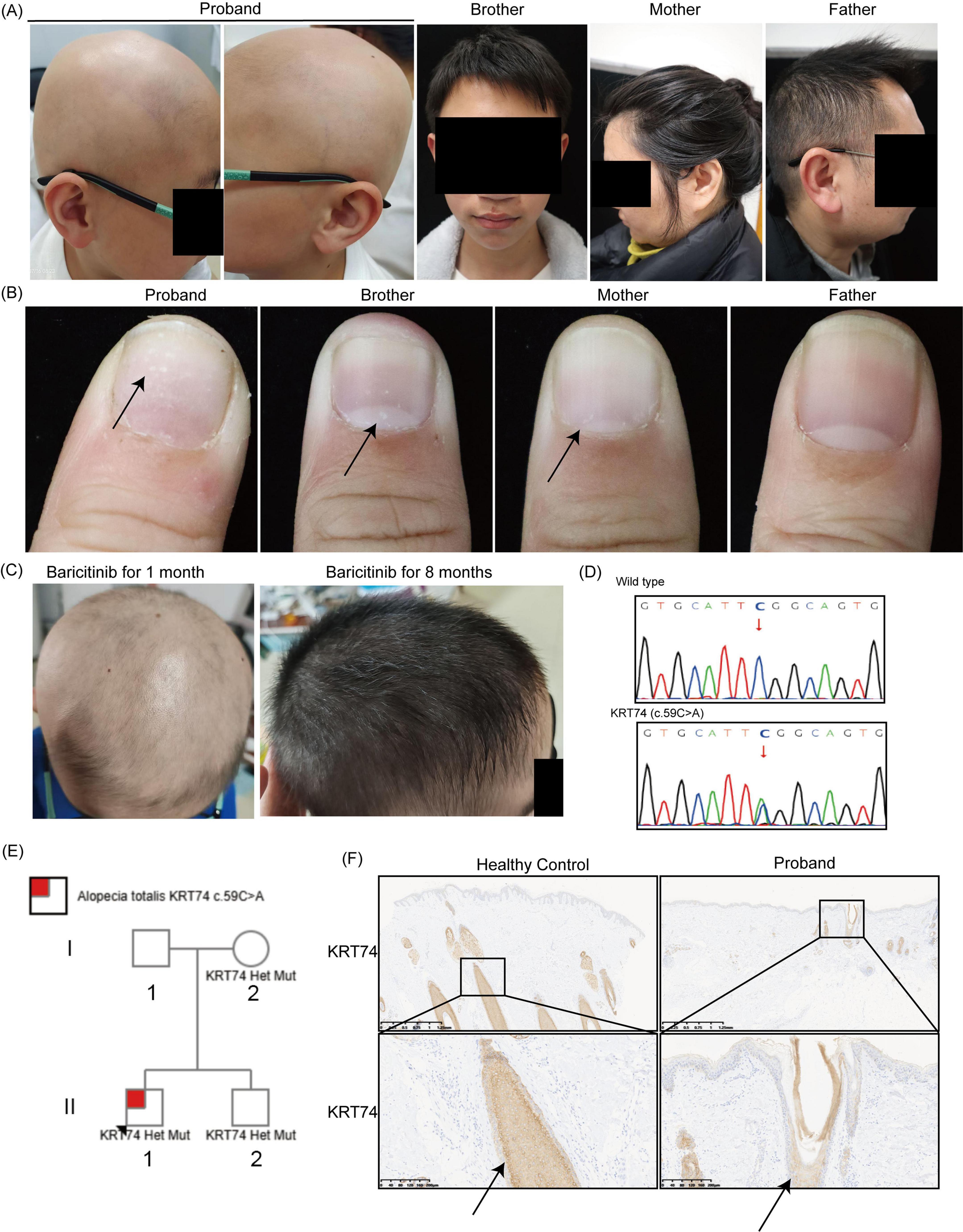 (A) Side and front views showing a bald proband and other family members with hair. (B) Close-ups of fingernails showing noticeable differences. (C) Top views of the scalp showing hair regrowth after one and eight months of Baricitinib treatment. (D) Genetic sequence graphs highlighting a mutation in KRT74. (E) Family pedigree indicating inheritance of the KRT74 mutation associated with alopecia totalis. (F) Histological comparison showing differences in KRT74 expression between healthy control and proband hair follicles.
