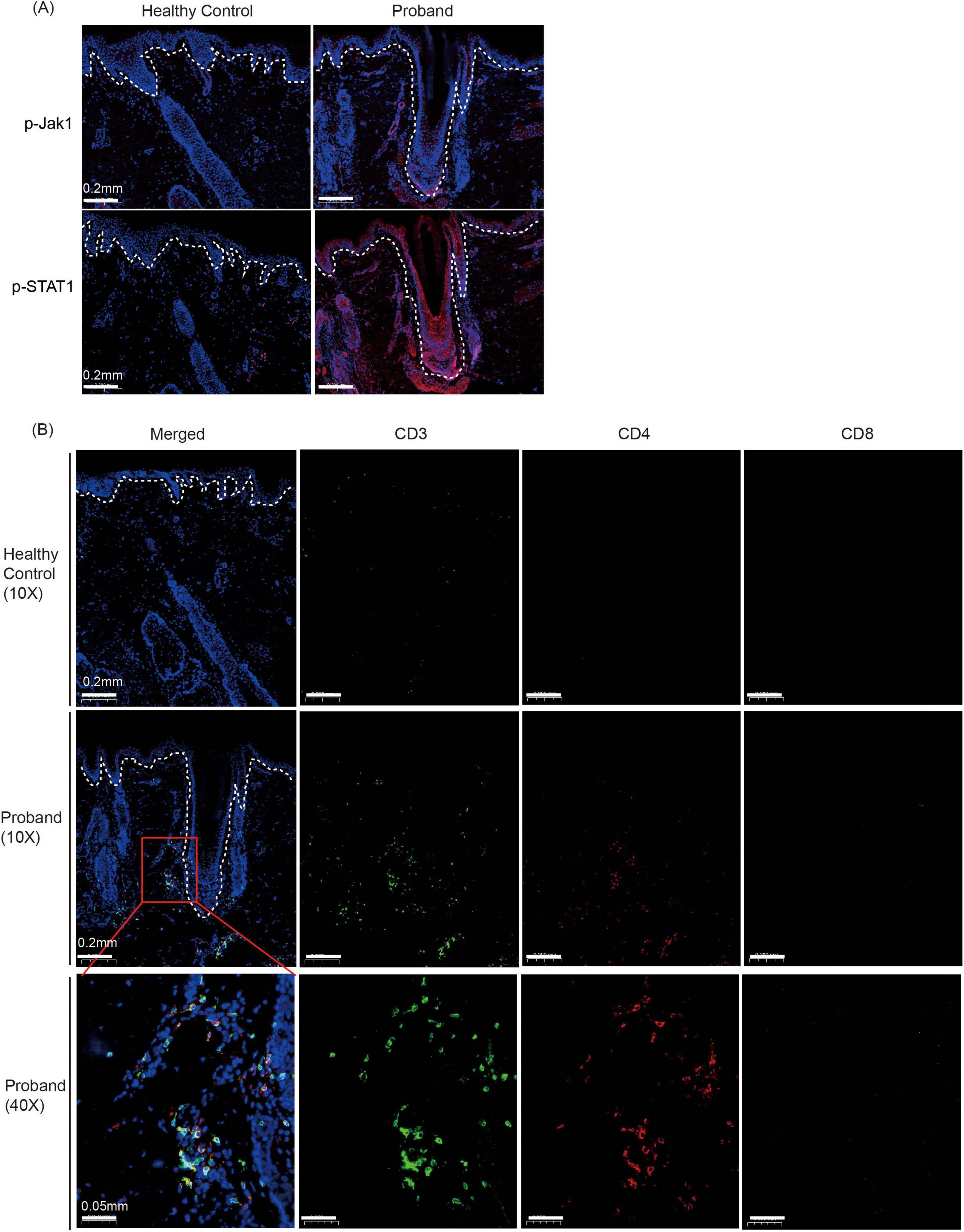 “(A) Two panels compare p-Jak1 and p-STAT1 expression in skin sections from a healthy control and a proband. The proband shows increased expression with highlighted regions in pink and red, respectively. (B) Three panels show immunofluorescence of CD3, CD4, and CD8 in skin sections. The proband samples display noticeable green and red staining at 10X and 40X magnifications, contrasting with the healthy control.”