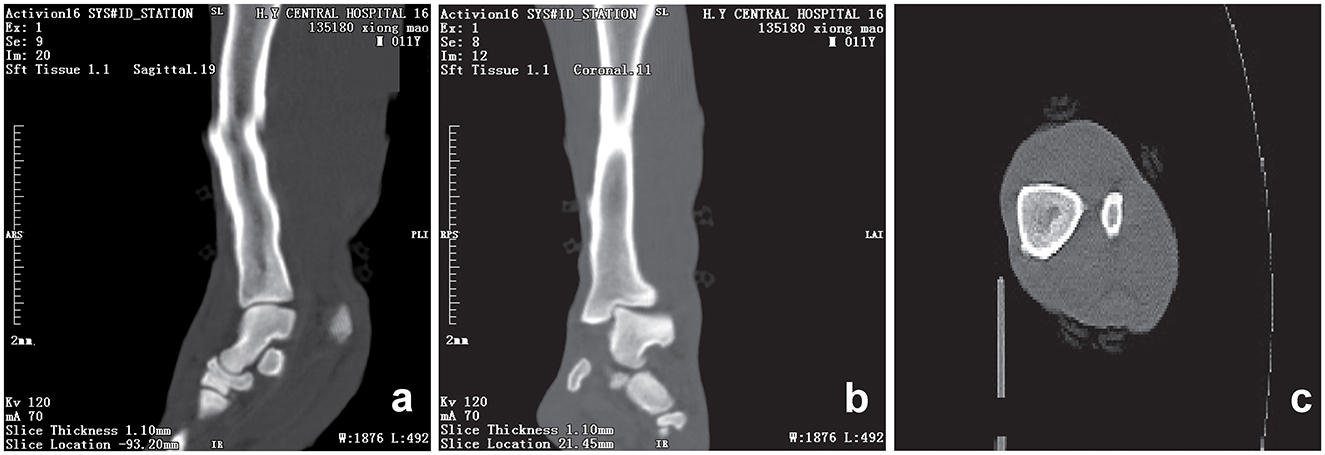CT scan images showing different sections of a lower limb. Image a displays a sagittal view with alignment of bones. Image b shows a coronal view highlighting joint structure. Image c presents a transverse cross-section illustrating bone density and surrounding tissue.