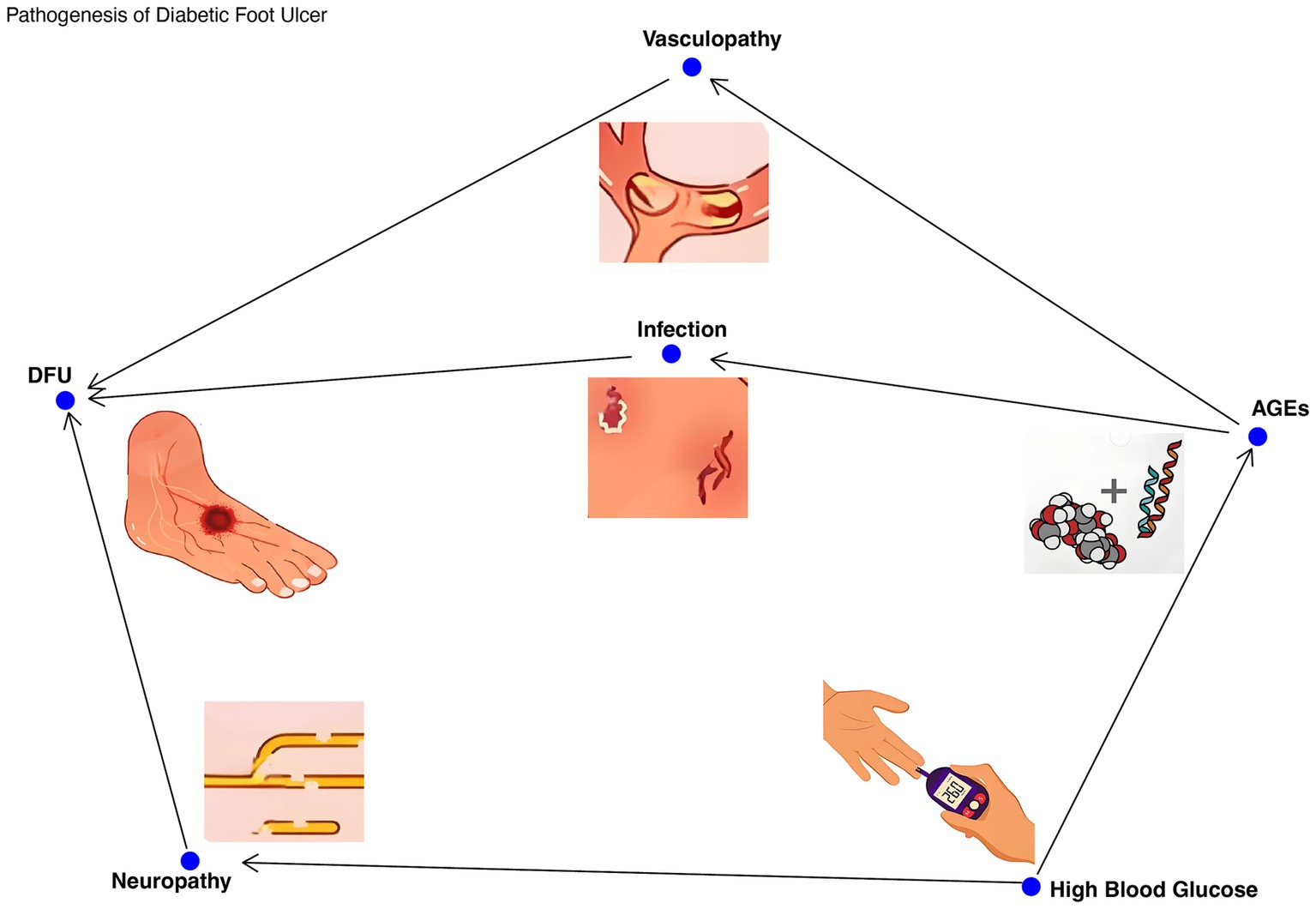 Flowchart illustrating the pathogenesis of diabetic foot ulcer (DFU). Key components include vasculopathy, neuropathy, infection, advanced glycation end products (AGEs), and high blood glucose, interconnected by arrows. Each component is depicted with illustrations, such as a foot with an ulcer and a blood glucose test.