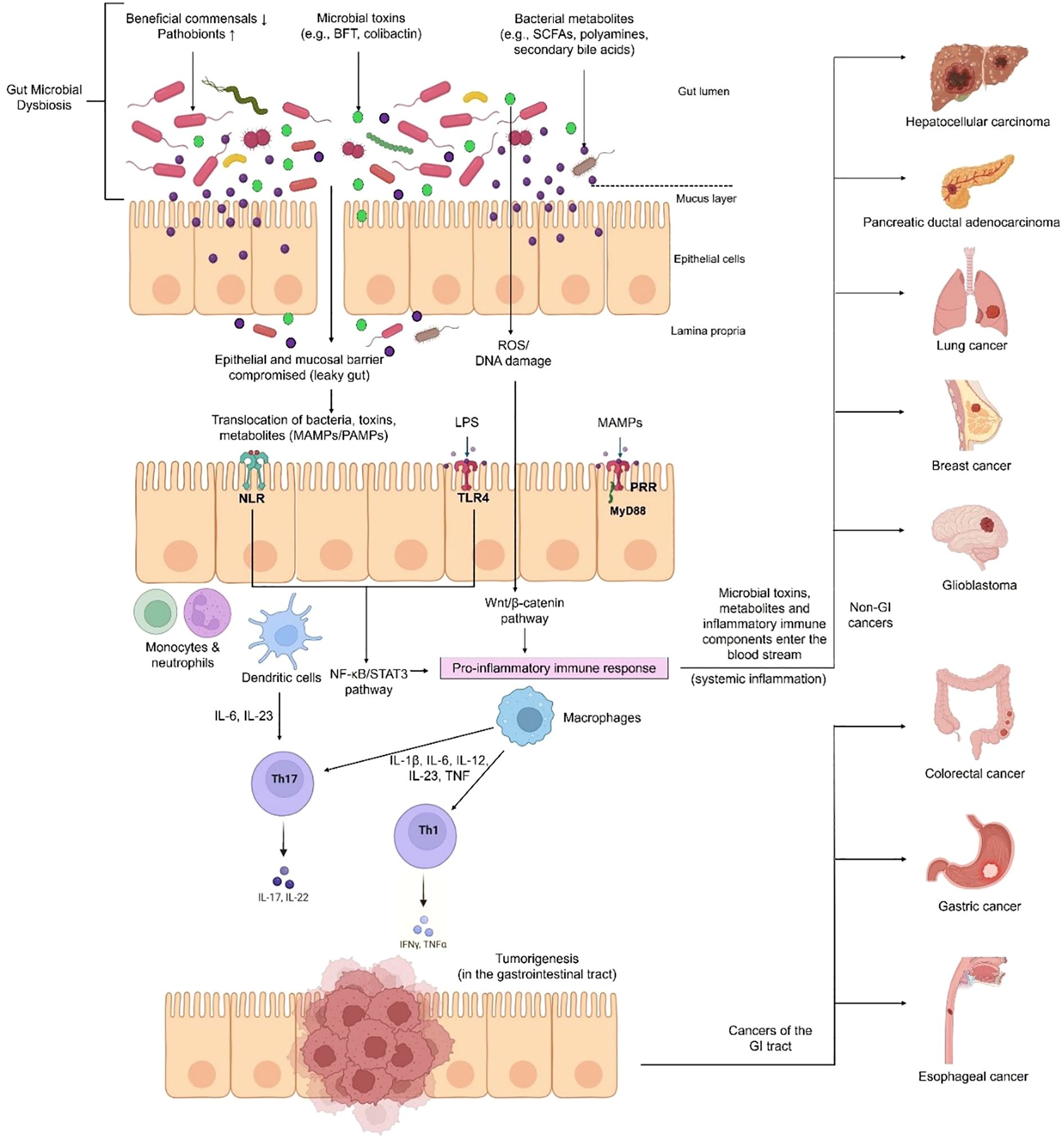 Diagram illustrating gut microbial dysbiosis and its link to cancers. It shows how microbial imbalances lead to epithelial barrier damage and immune responses. Pathways include NF-κB/STAT3 and Wnt/β-catenin, leading to inflammation and tumorigenesis. Associated cancers include colorectal, gastric, esophageal, hepatocellular carcinoma, pancreatic, lung, breast, and glioblastoma.