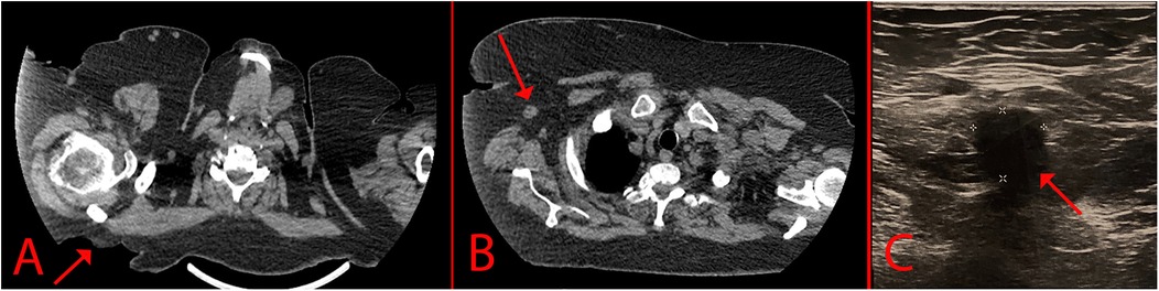 CT scan and USG images of the lesion. Image A shows a CT scan that demonstrates a skin defect; Image B shows an enlarged axillary lymph node in the subcutaneous fat of the axilla; Image C demonstrates a USG scan of the axillary lymph node.