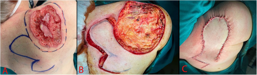 A three-panel image showing a surgical procedure. Panel A shows a wound with a surgical marking on the shoulder. Panel B displays a surgical incision and exposed tissue. Panel C shows the wound closed with sutures, following reconstruction.