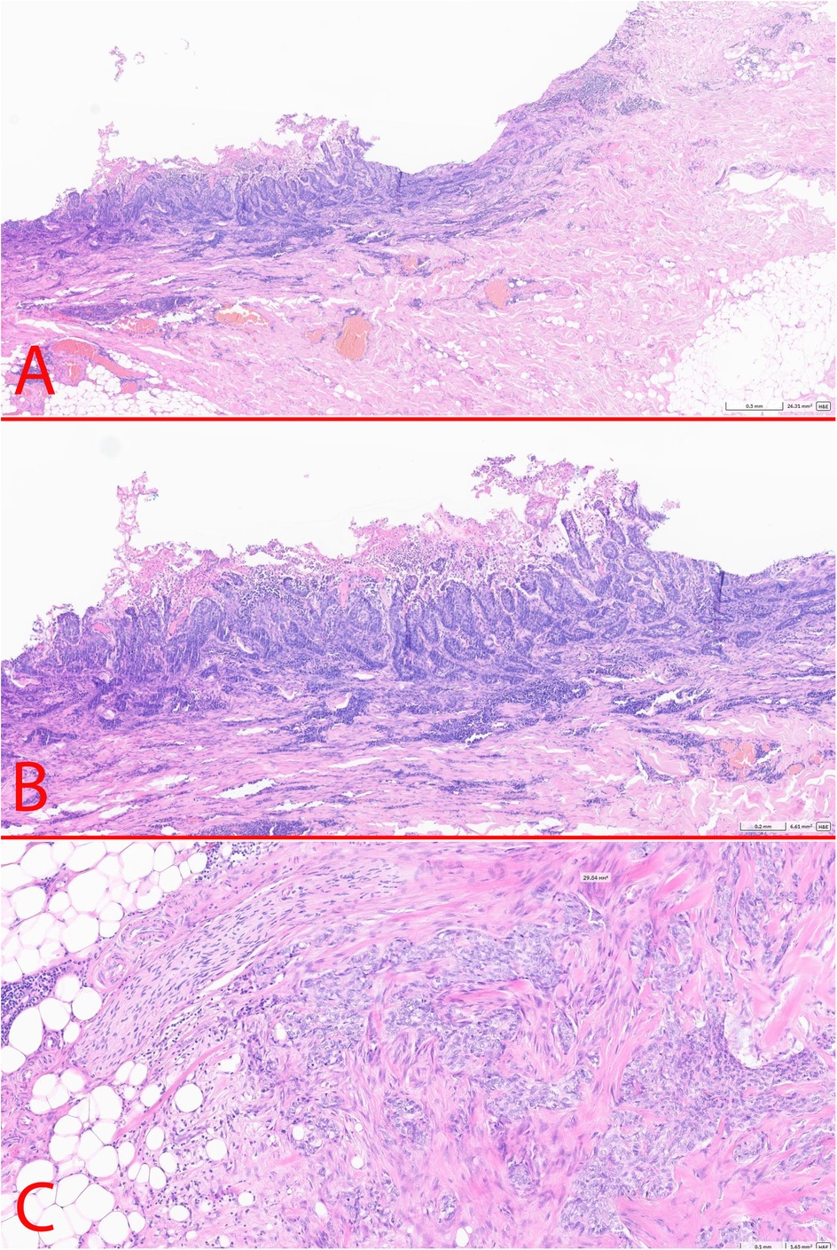 Postoperative histology. Panel A and B demonstrates BCC of the skin; Panel C demonstrates axillary metastasis in the subcutaneous fat far from the original tumour.