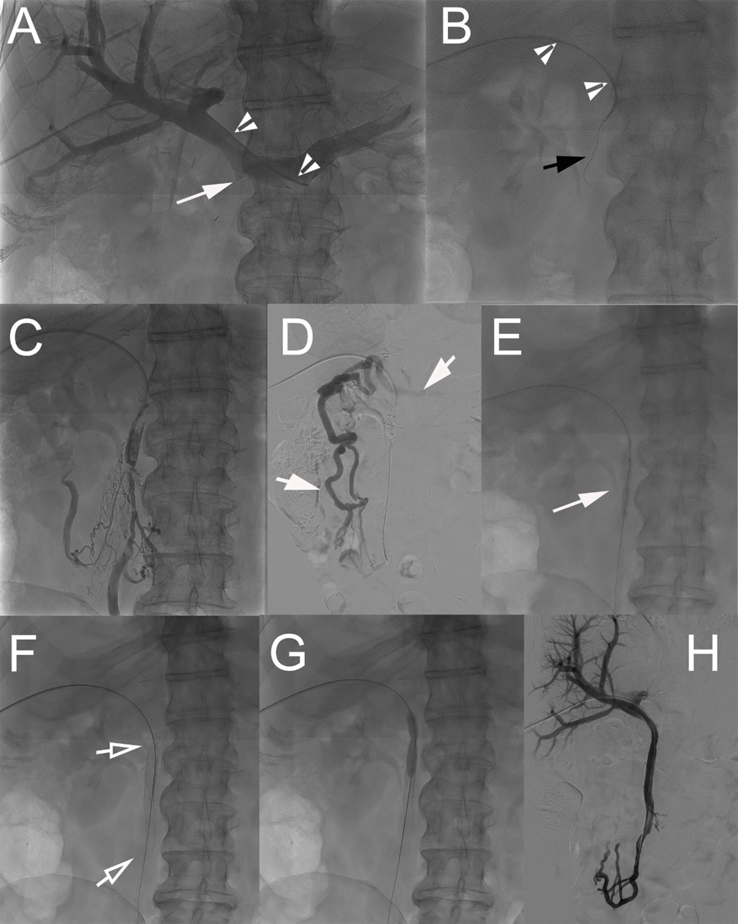 A series of eight grayscale X-ray images labeled A to H, showing various stages and views of angiographic procedures. Images depict arterial structures with contrasting materials, marked by arrows indicating areas of interest, such as specific arteries or catheter placements. Each image illustrates different anatomical views, focusing on the vascular system, likely highlighting diagnostic or therapeutic interventions.