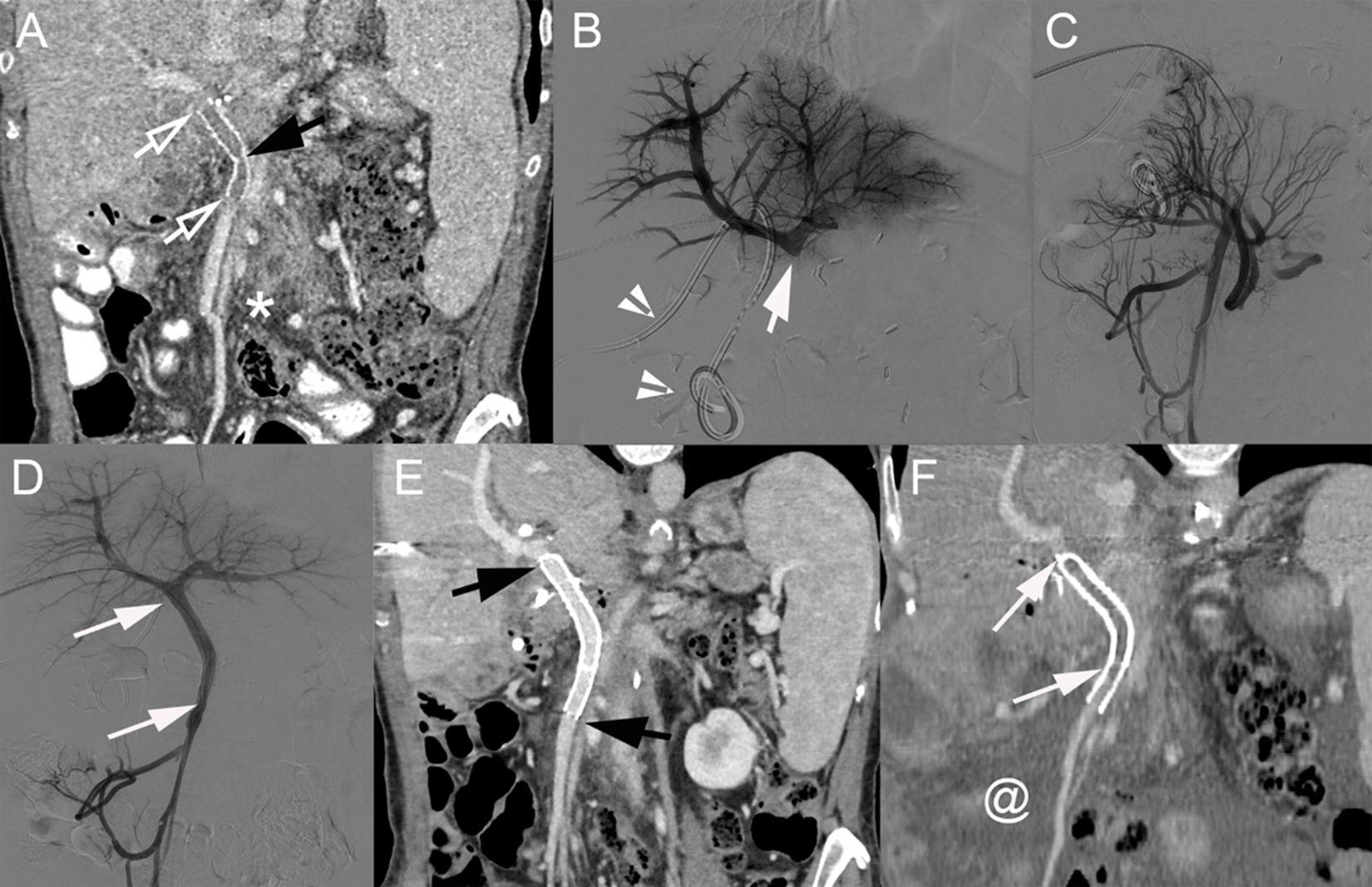 Medical imaging series depicting various views of abdominal vasculature and organs. Panel A shows a coronal CT scan highlighting blood vessels with arrows indicating specific areas. Panel B presents an angiogram of arterial branches. Panel C offers a lateral angiogram view. Panel D reveals additional conduits with arrows marking regions of interest. Panel E shows another CT view with prominent vascular structures highlighted. Panel F illustrates a CT scan focusing on upper abdominal regions with arrows pointing to specific features. The images collectively emphasize detailed vascular anatomy and potential clinical areas of interest.