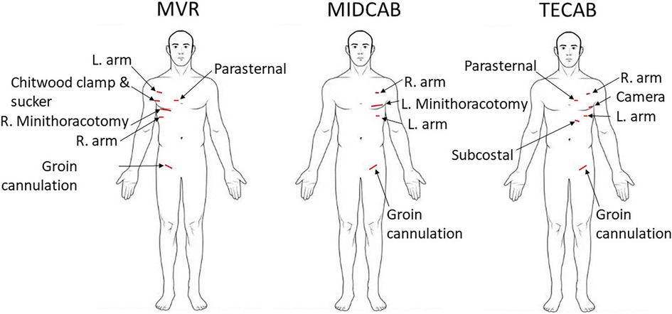 Diagrams illustrate three surgical techniques: MVR, MIDCAB, and TECAB. Each shows a human figure with labeled incision points. MVR includes Chitwood clamp, sucker, right minithoracotomy, groin cannulation. MIDCAB has left minithoracotomy, subcostal, groin cannulation. TECAB features camera, right arm, groin cannulation.