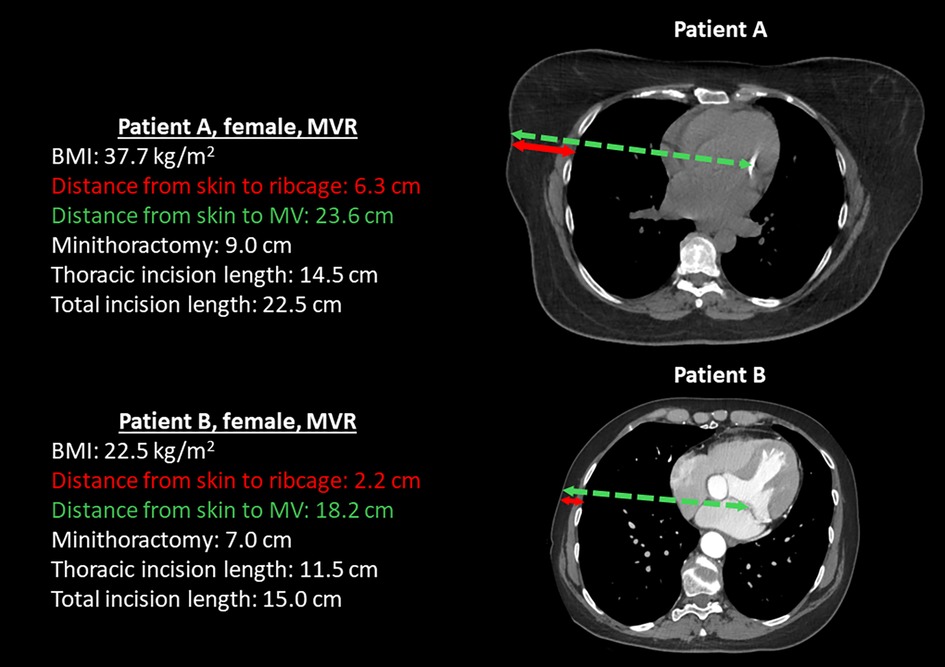 CT images compare two patients, A and B, both females undergoing mitral valve replacement. Patient A has a BMI of 37.7 kg/m², with distances from skin to ribcage and mitral valve at 6.3 cm and 23.6 cm, respectively. Surgical measurements include a minithoracotomy of 9.0 cm, a thoracic incision of 14.5 cm, and a total incision length of 22.5 cm. Patient B has a BMI of 22.5 kg/m², with distances from skin to ribcage and mitral valve at 2.2 cm and 18.2 cm. Her minithoracotomy is 7.0 cm, with a thoracic incision of 11.5 cm, totaling 15.0 cm.