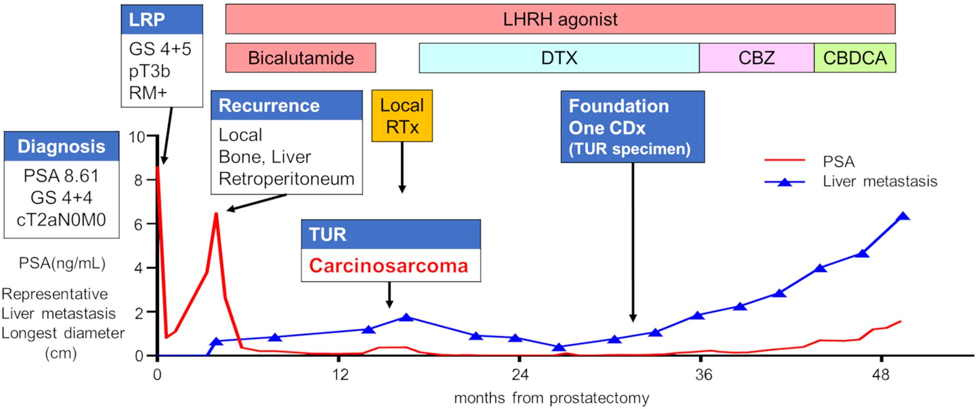 A timeline chart showing prostate-specific antigen (PSA) levels and liver metastasis progression over 60 months post-prostatectomy. PSA levels are in red, liver metastasis in blue. Key events include diagnosis, recurrence, local treatment, and medication changes. Arrows highlight transitions at various stages, such as LHRH agonist, DTX, CBZ, and CBDCA treatments.