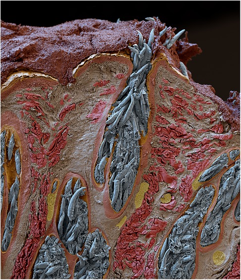 Electron microscope section through a heavily infested canine sebaceous gland. Hundreds of long-bodied Demodex are visible, shaded blue, packed tightly into vesicles deep in the skin and blocking the very distended pore, with dark exuded material on the skin surface.