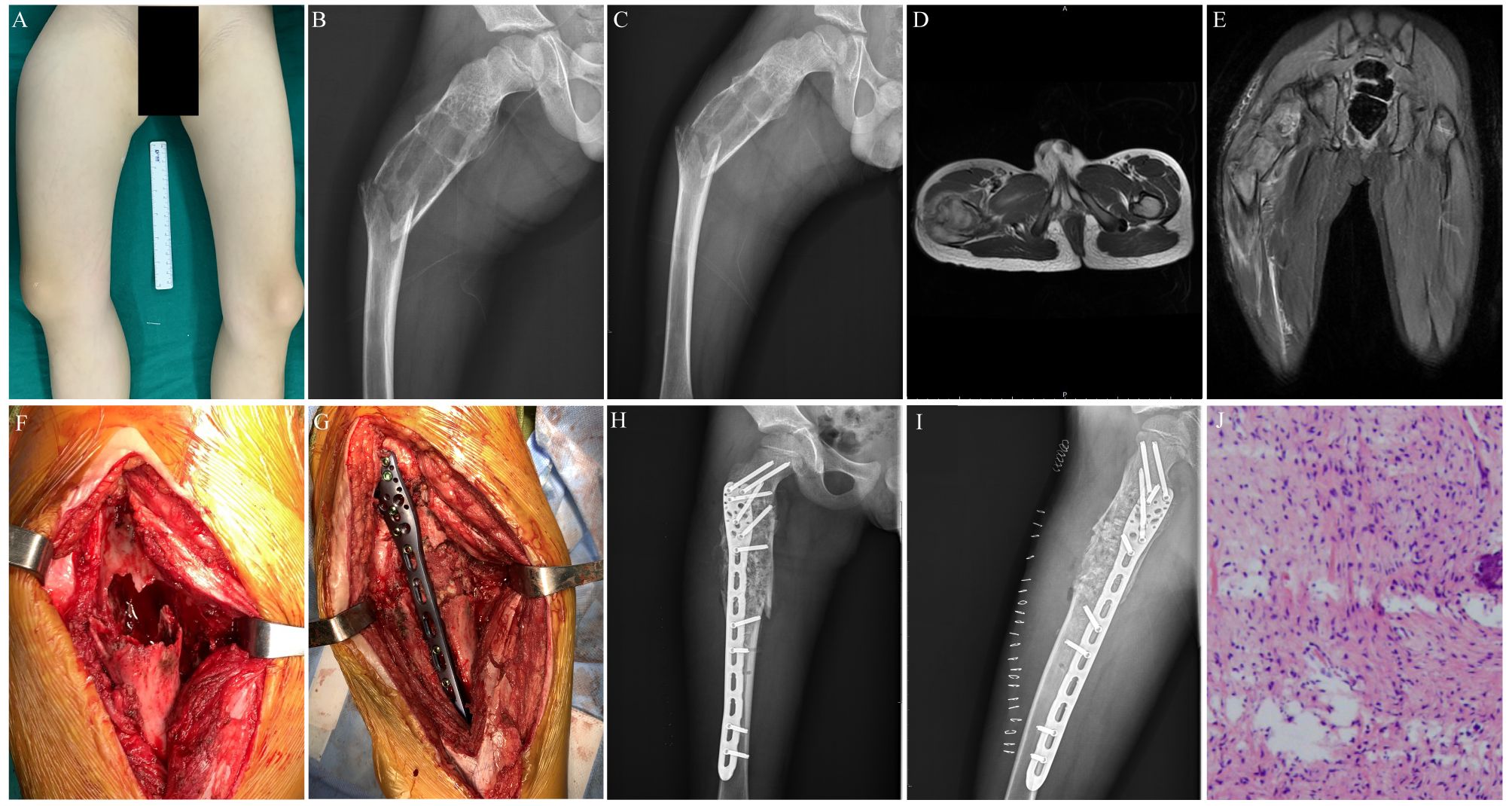 A series of images related to a medical case show the following: (A) A clinical photograph of a person's upper legs with a ruler for scale. (B, C) X-ray images showing a femur with a bone lesion. (D, E) MRI scans exhibiting cross-sectional and coronal views of the femoral region. (F, G) Intraoperative photos of surgical exposure and fixation of the femur using a metal plate. (H, I) Postoperative X-rays indicating the internal fixation of the femur with a metal plate and screws. (J) A histological slide displaying cellular details under a microscope.