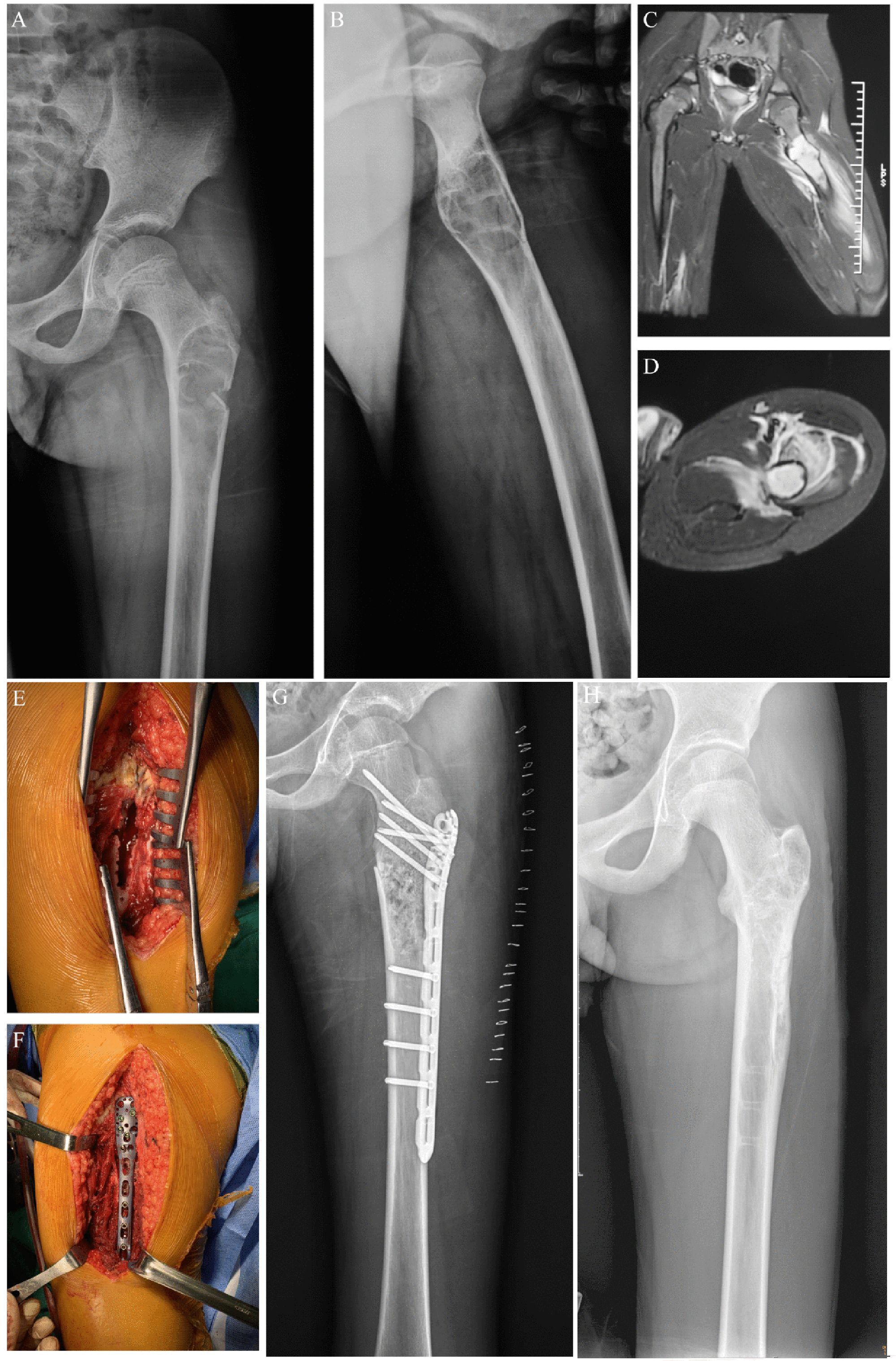 X-ray and MRI images of a hip, followed by surgical and post-operative views. Panel A and B: X-rays showing the hip and femur. Panel C and D: MRI scans displaying cross-sectional views. Panel E and F: Surgical images with open incisions revealing the procedure site. Panel G: Post-operative X-ray with metal fixation in the femur. Panel H: Follow-up X-ray indicating healing progress.