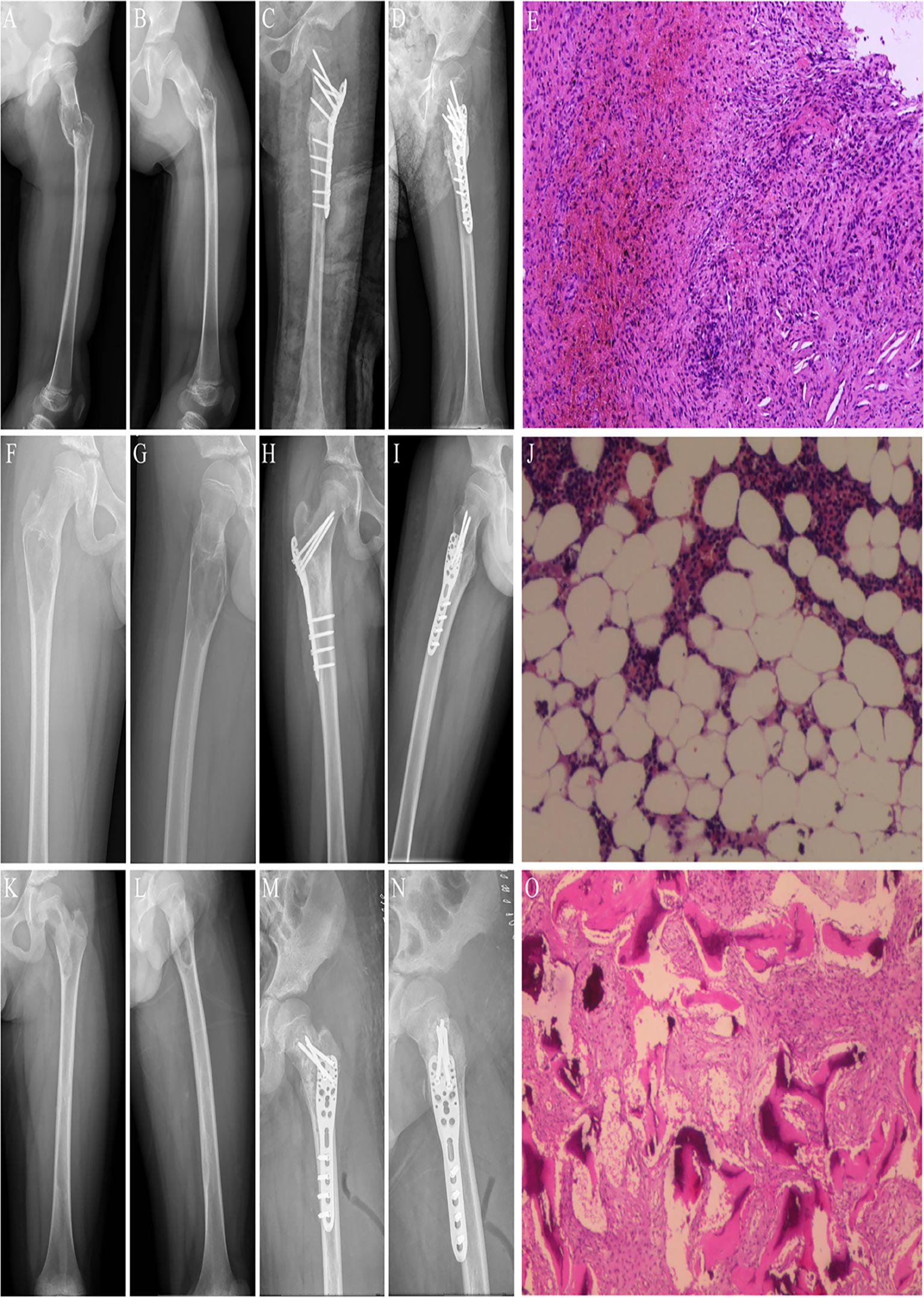 An array of medical images and histology slides. Panels A, B, F, G, K, and L depict X-rays of a femur showing fractures. Panels C, D, H, I, M, and N display post-operative X-rays with internal fixation devices. Panels E, J, and O present histological slides with varying tissue structures under a microscope, showcasing different levels of cellular detail and staining patterns.
