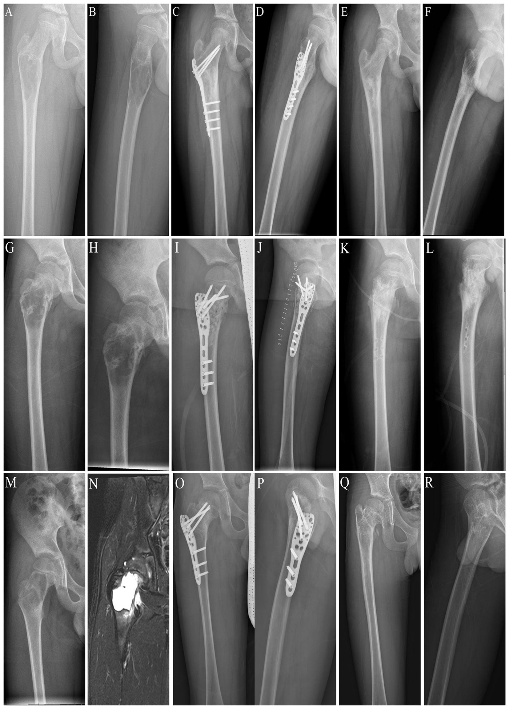 X-ray and MRI images of a hip fracture and subsequent treatments. Images A and B show the initial fracture. C and D display surgical fixation with plates and screws. E and F reveal post-surgical healing. G and H depict similar fractures in another patient. I and J illustrate different fixation techniques. K and L show follow-up images. M and N focus on another hip fracture and MRI details. O and P again show surgical intervention. Q and R depict the final recovery stages.