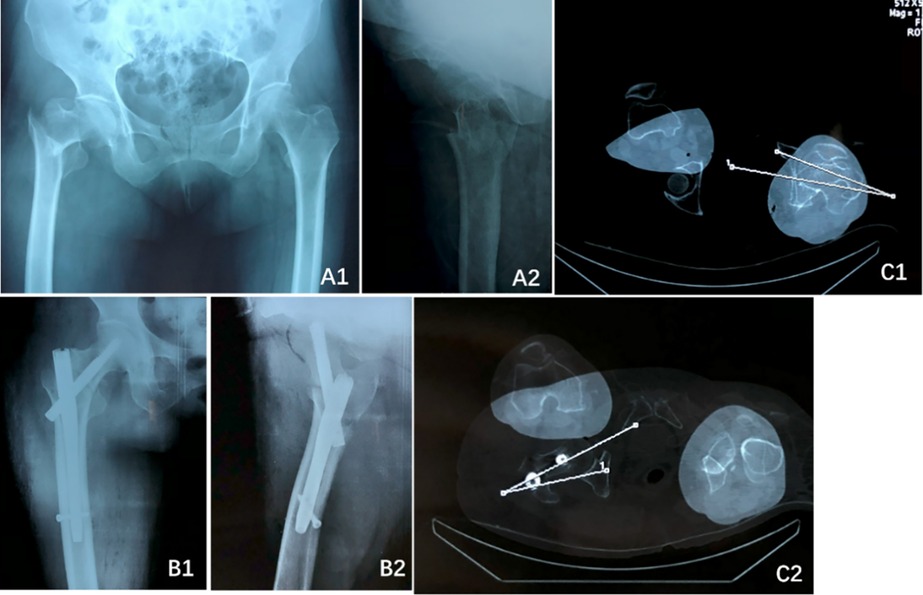 Composite image of x-rays and CT scans of the pelvis and femur. A1 shows a frontal pelvis x-ray, A2 a lateral femur x-ray with a fracture, B1 and B2 show x-rays of internal fixation with a rod and screws, and C1 and C2 show CT scans of femur alignment with measurement lines.