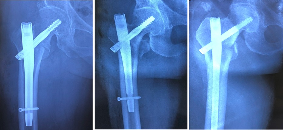 X-ray images in a vertical triptych display a close-up of a hip with orthopedic implants. Each image shows a metal rod and screws securing a fractured femur. The images illustrate different angles of the hip joint, emphasizing the surgical hardware alignment and placement.